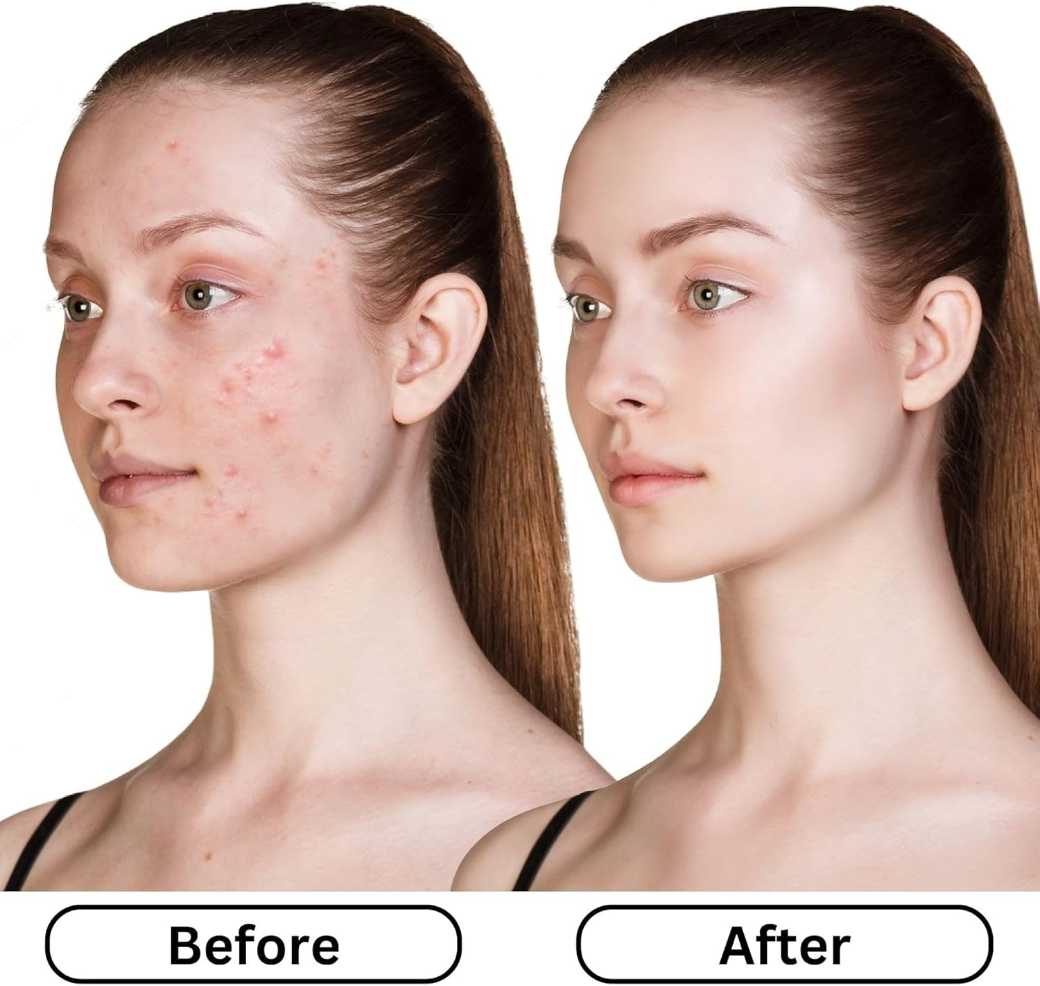 Ivanka Kojic & Glutathione Acne Soap image number 5