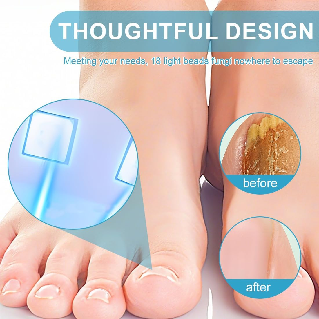 Tomedeks 1 X Nail Fungus Laser with Timer, Nail Fungus Laser Device, Infrared Strongest Effect, Fast Acting image number 1