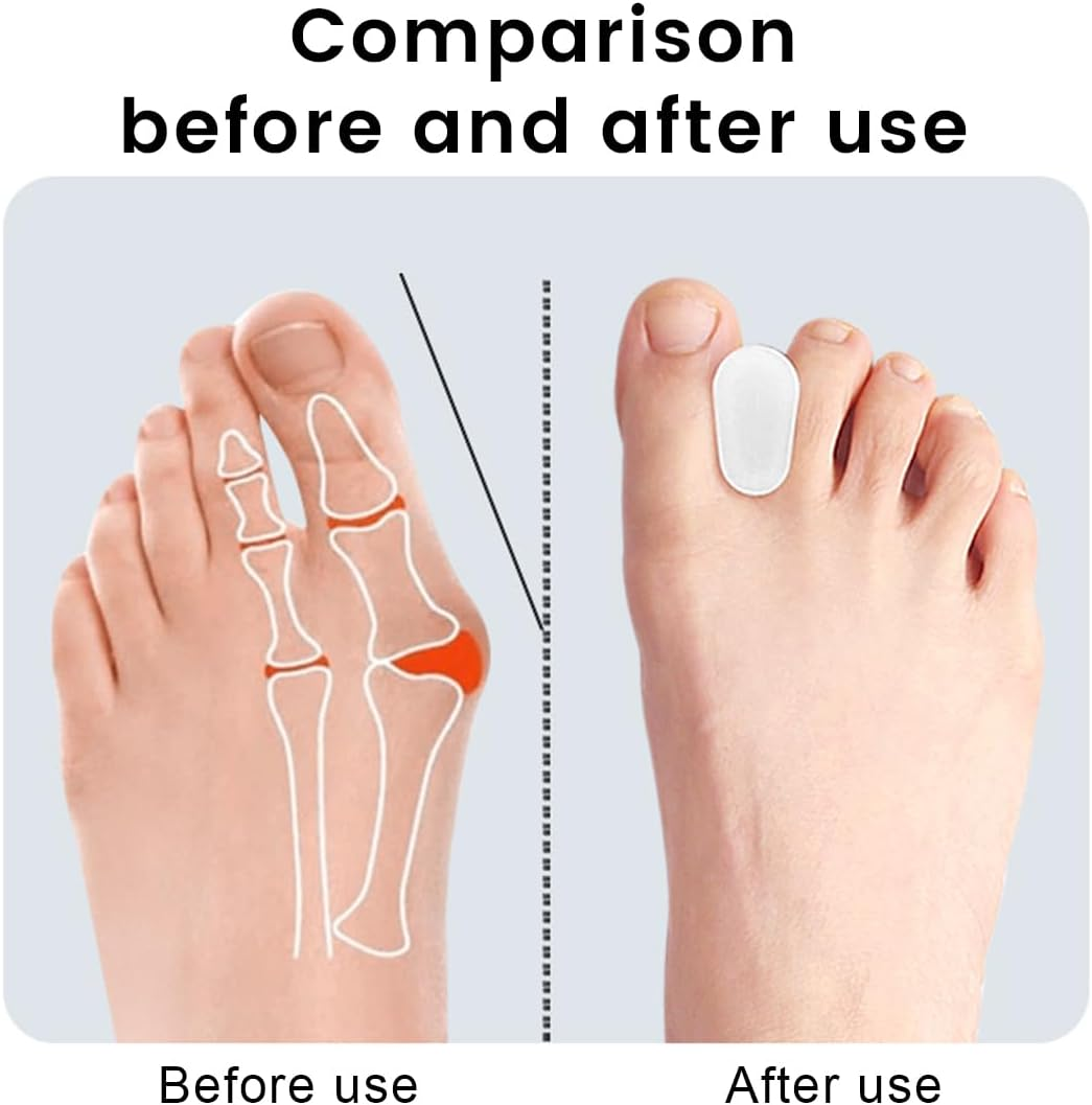 Toe Separators, 12-Piece Set Toe Separators for Hallux Valgus, Bunion & Toe Correction, Silicone Toe Spacer for Men and Women (Small Size)