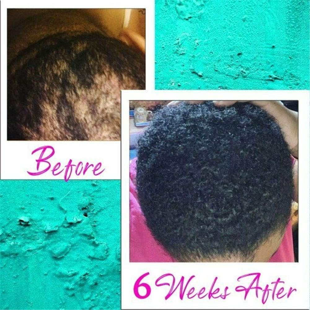 Hair Regrowth Serum-Hair Growth Essence Oil, Hair Growth Treatment, Stops Hair Loss, Thinning,Balding, Promotes Thicker, Fuller and Faster Growing Hair image number 5