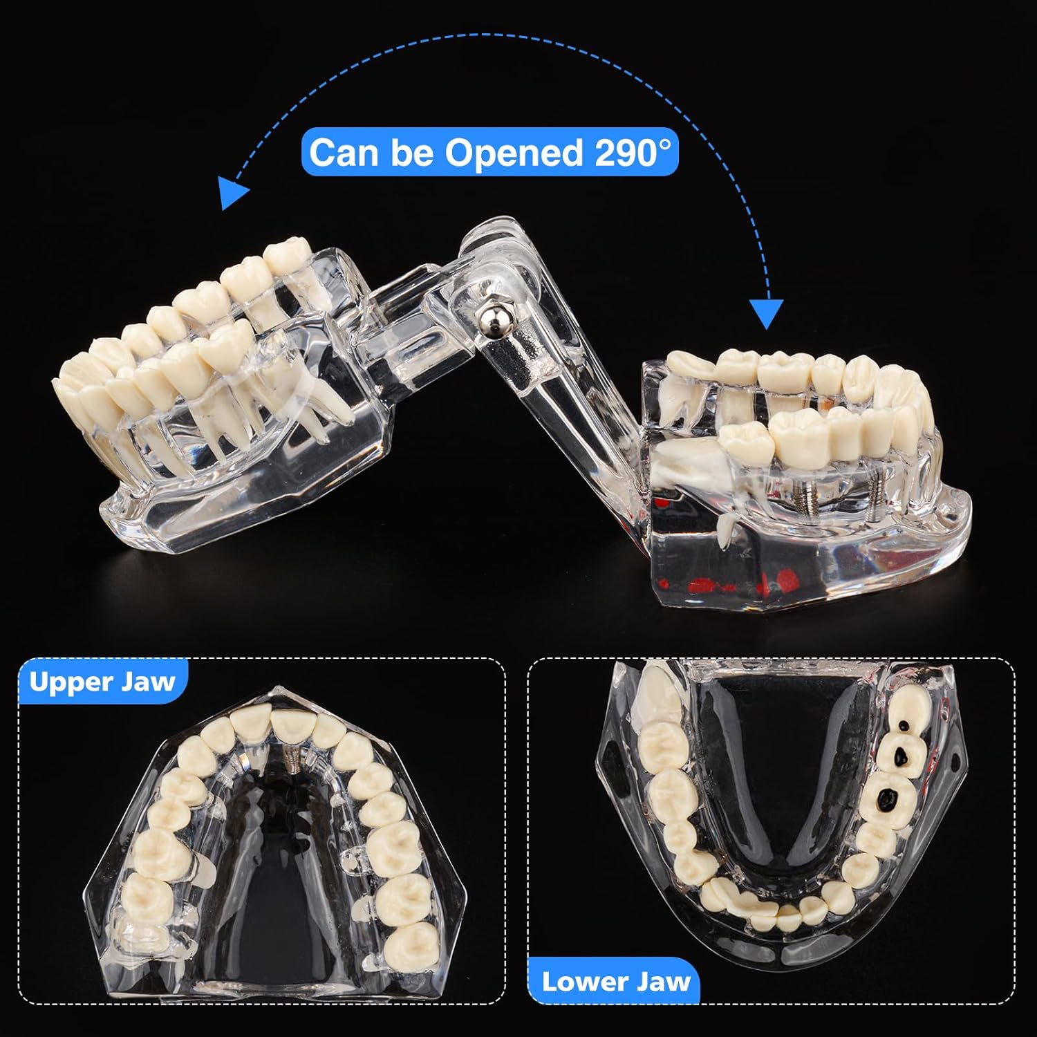 Ultrassist Transparent Disease Teeth Model image number 6