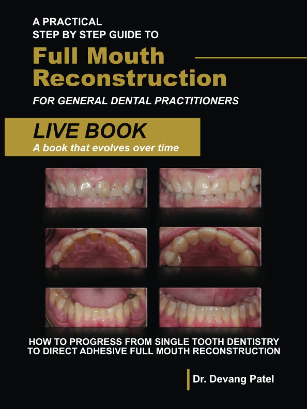 A Practical Step by Step Guide to Full Mouth Reconstruction for General Dental Practitioners: How to Progress from Single Tooth Dentistry to Direct Adhesive Full Mouth Reconstruction image number 2