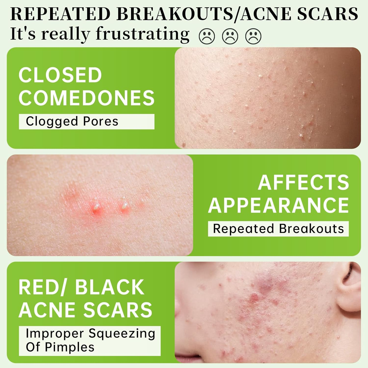 Azelaic Acid Face Serum, Azelaic Acid 10% Hyaluronic Acid Serum for anti Aging, Reduces Acne, Boosts Skin Fimness & Improves Skin Tone, Korean Skincare for All Skins, 30Ml image number 2