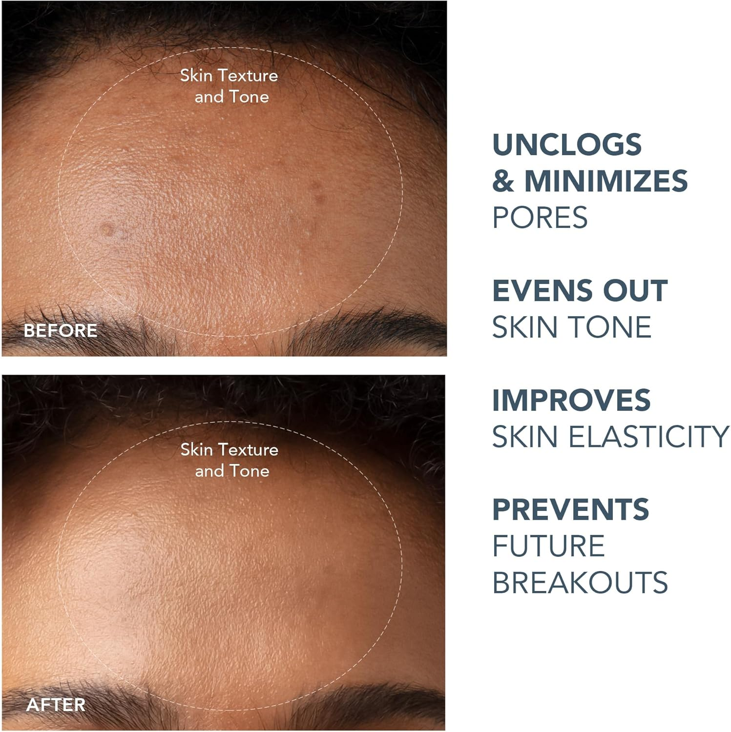 FOREO Blackheads Suck KIWI Bundle - Whitehead & Black Head Remover for Face + LUNA Micro-Foam Cleanser 2.0, 100 Ml - Vacuum Skin Care Tools - Blackhead Extractor for Face & Nose - No Pore Strips image number 4