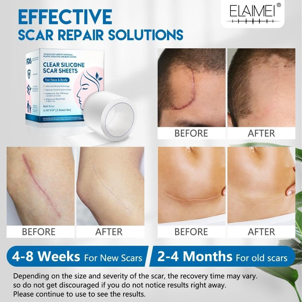 Clear Silicone Scar Sheets for Face & Body &ndash; Medical-Grade Silicone Gel, Improves & Heals Scars, Waterproof, Breathable, Easy to Cut (Roll Size 0.98" X 59", 2.5Cm X 1.5M)