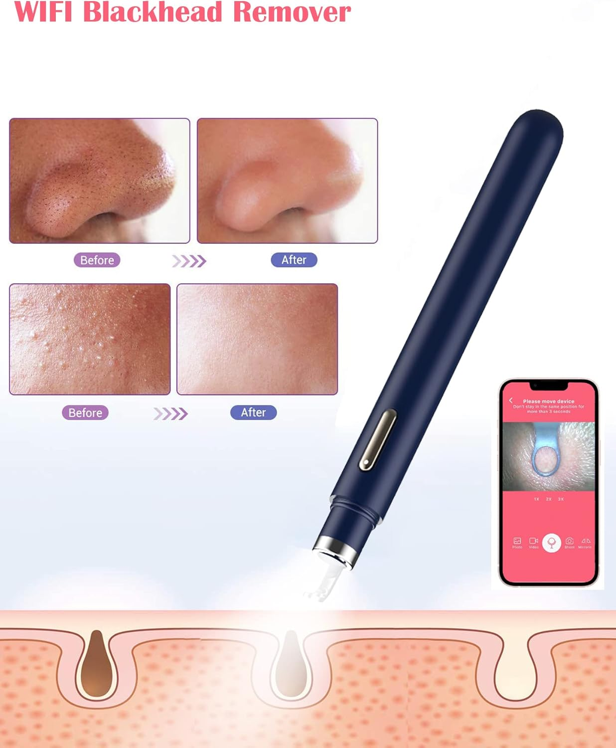 Blackhead Remover Tools with Camera Visible Pore Cleaner Waterproof Acne Comedone Whitehead Extractor Kit for Iphone/Android image number 4