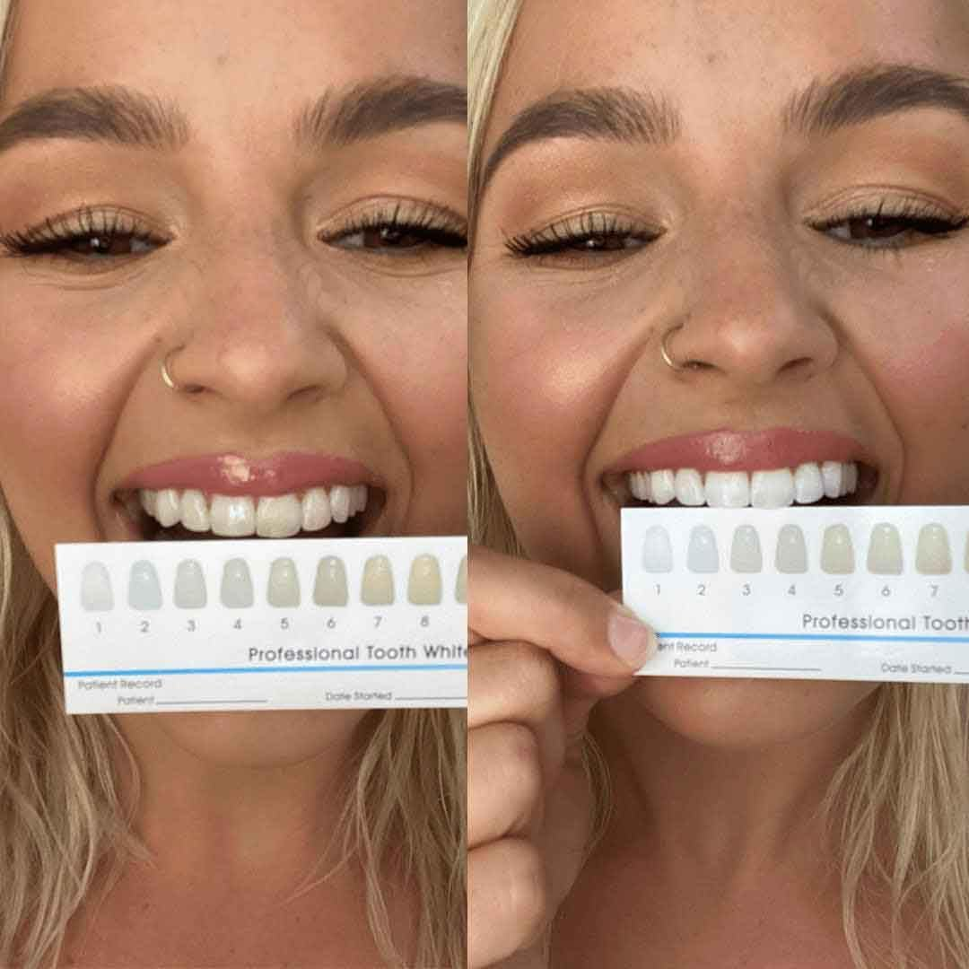 Smilepro Advanced Teeth Whitening Kit &ndash; LED Light & Whitening Pens &ndash; Enamel Safe, No Sensitivity &ndash; At-Home Teeth Whitener for Coffee, Wine & Smoking Stains image number 1