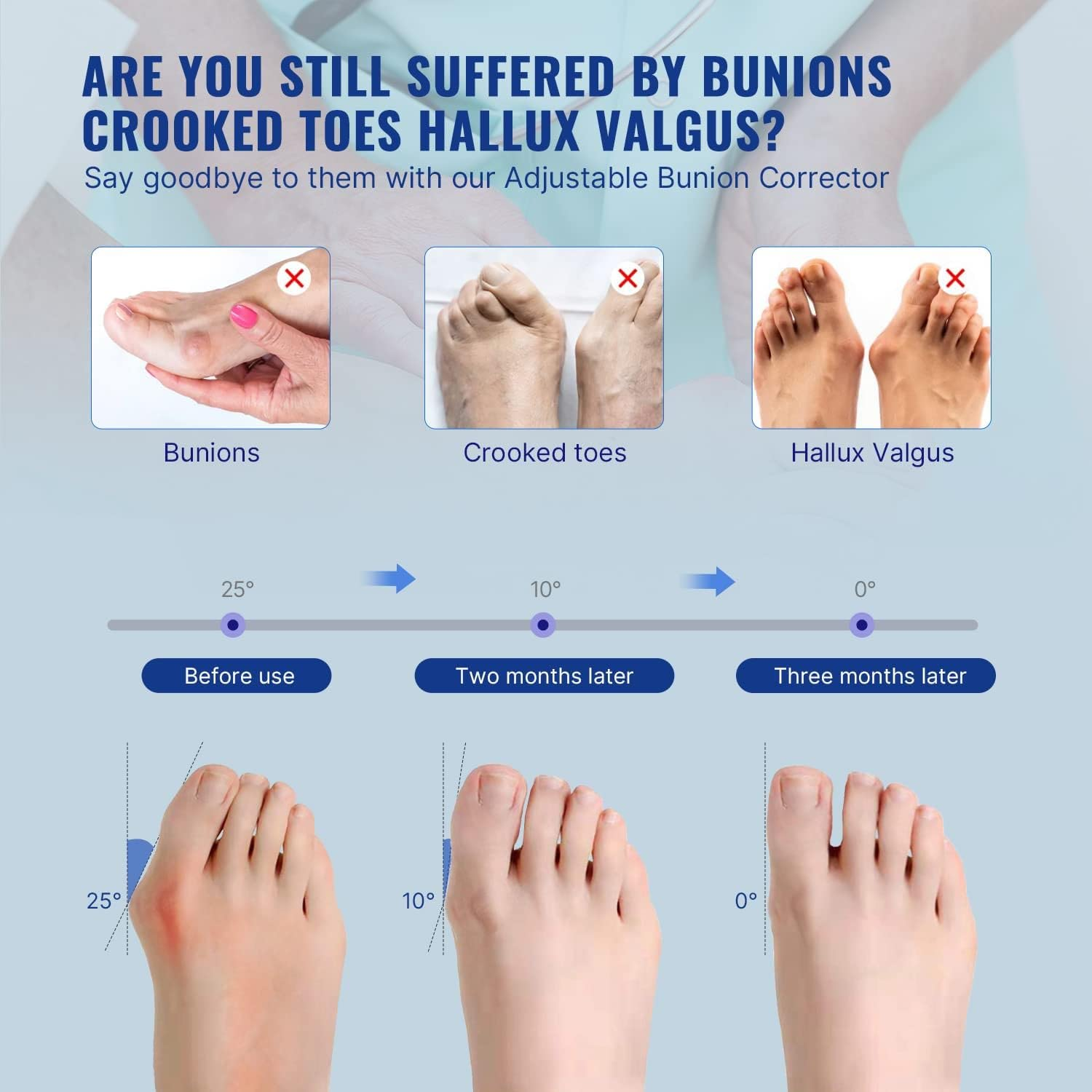 Bunion Corrector for Women(2 Pcs) Hallux Valgus Brace Splint Pads Bunion Big Toe Separators Straightener for Hallux Valgus Pain Relief Fits Men and Women image number 1