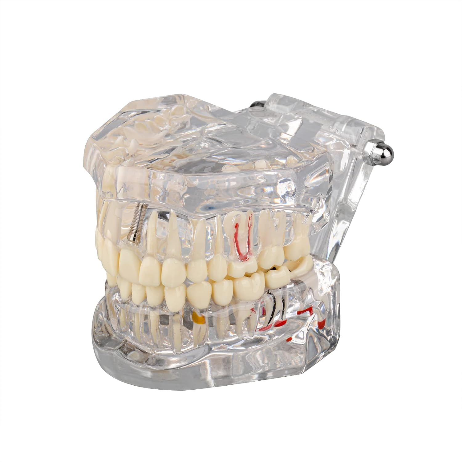 Ultrassist Transparent Disease Teeth Model image number 3