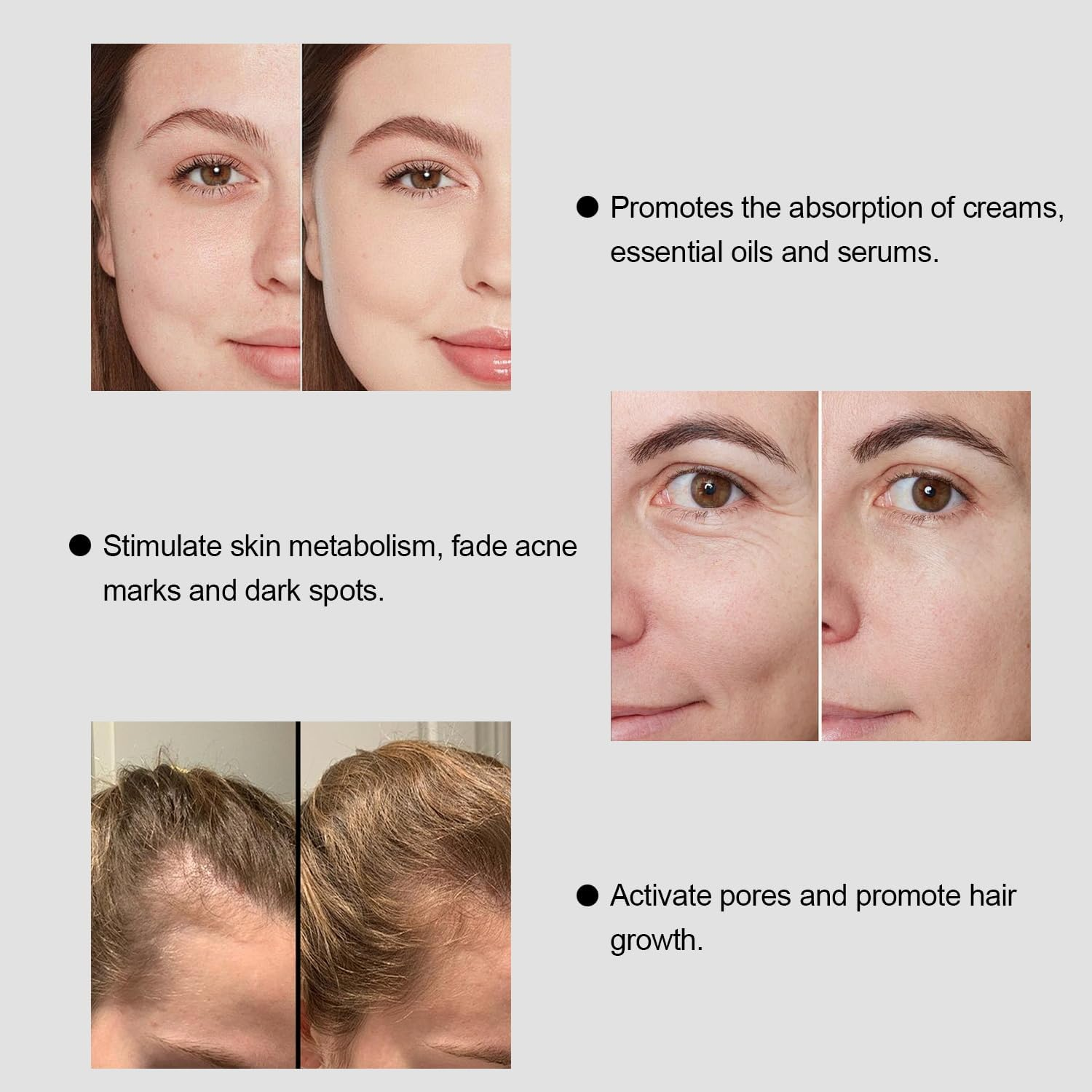 Simofuze Derma Stamp, Professional Derma Roller, 0-3Mm Adjustable Microneedling, 140 Needles Dermastamp, for Hair and Beard Growth, Improve Skin Condition, for Women and Men image number 6