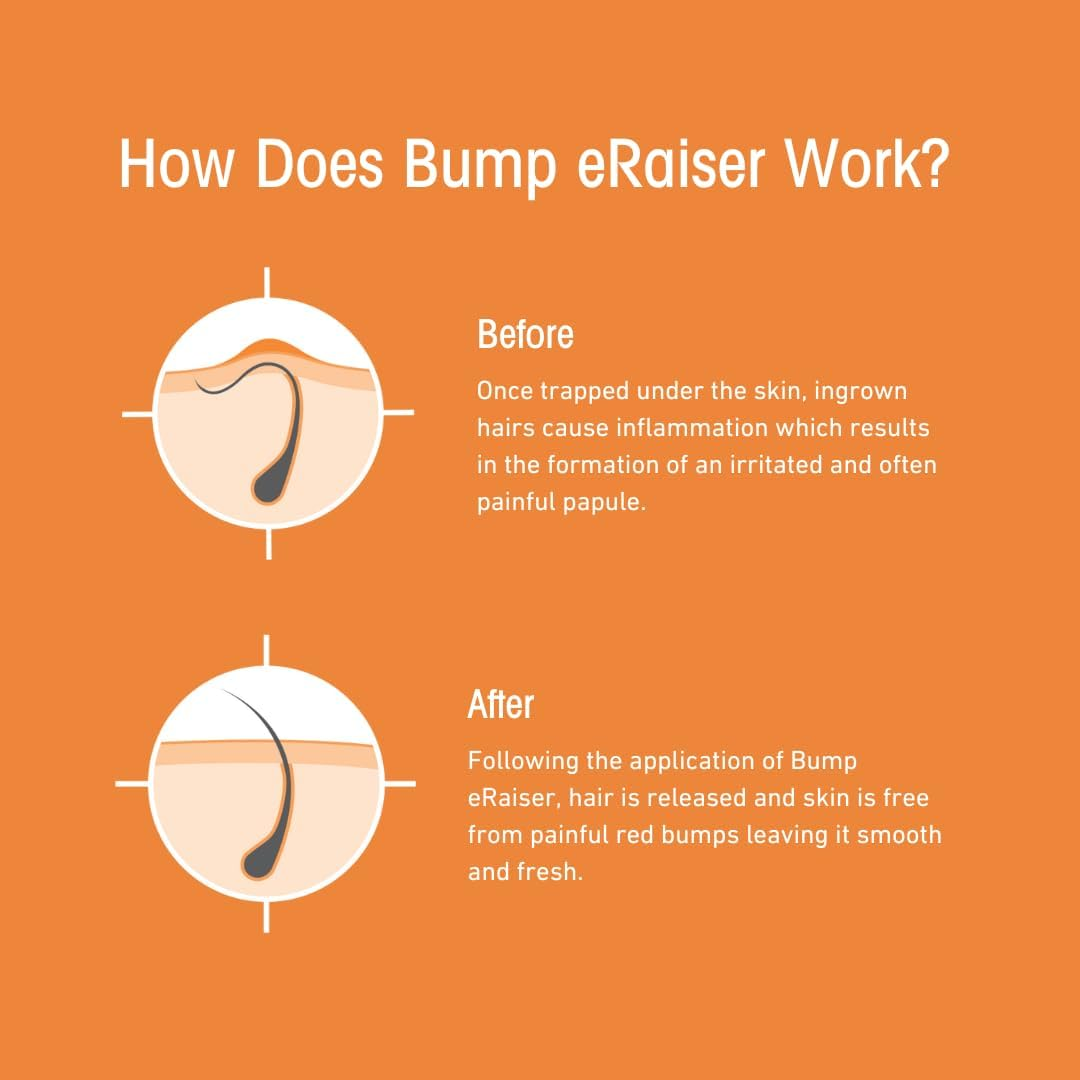 Bump Eraiser 5 Pack - the Complete Ingrown Hair Solution in 1 Convenient Pack