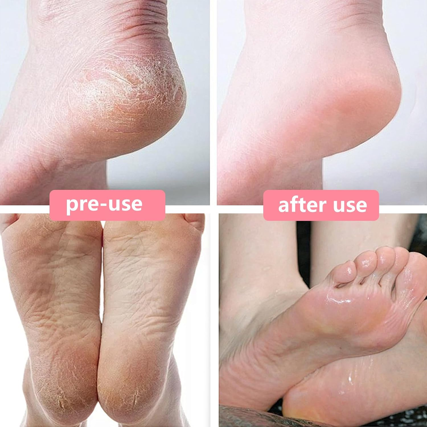 2 Pcs Foot Files Callus Remover Stainless Steel Foot Rasp and Dual Sided Foot File for Pedicure to Removes Hard Skin Corns for Dry and Wet Feet