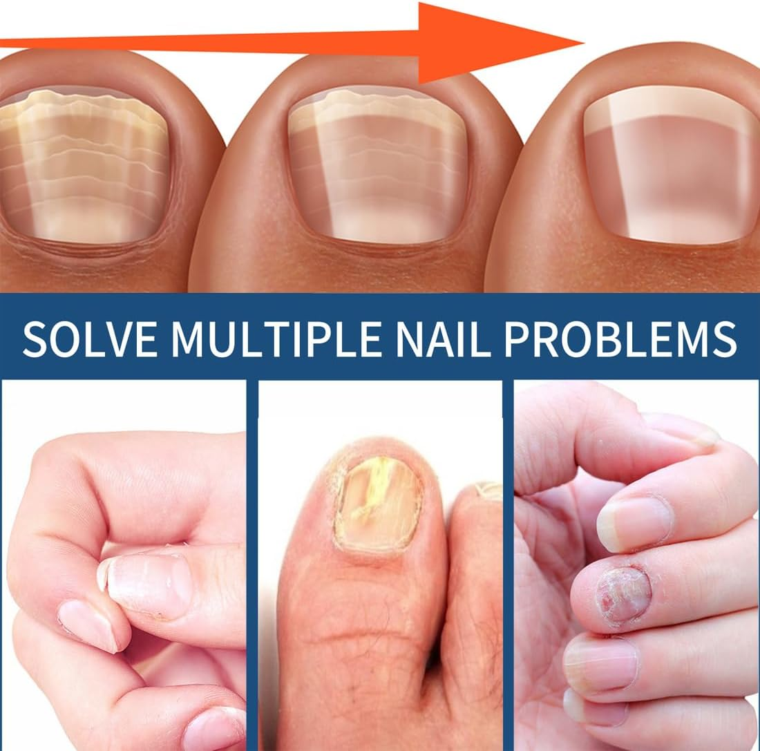 GXGM 32 Pieces Toenail Treatment, Nail Digging Repair Patches, Improve the Appearance of Discoloured Nails image number 2