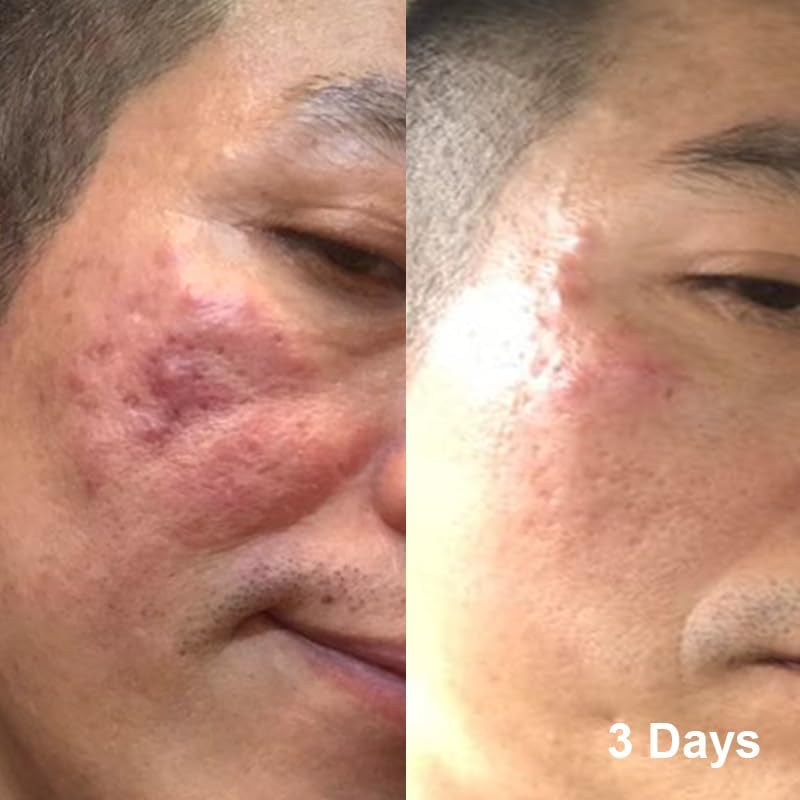 Non-Commodenic Moisturiser for Blemishes and Breackouts Prone Skin image number 5