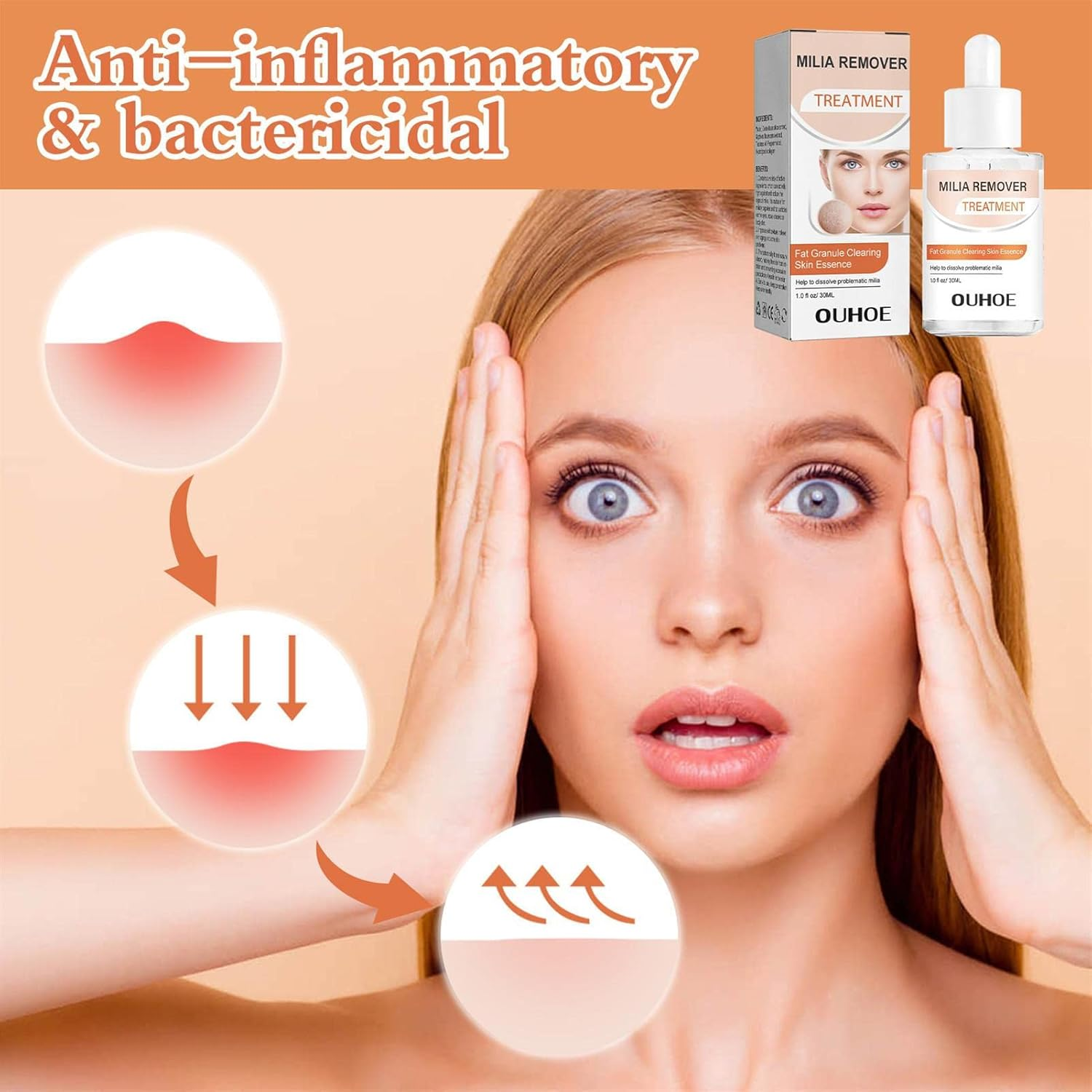 Milia Remover - 30Ml Gentle and Safe Milia Remover for Fat Granule Clearing - Milia Spot Skin Care Product Helps Dissolve and Reduce Milia, Works Face And image number 1