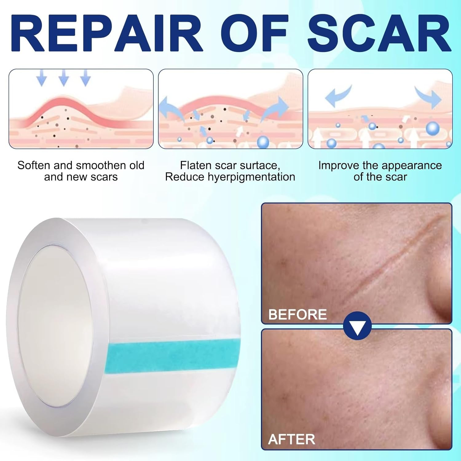 Transparent Silicone Scar Patch Tape ● Reusable, Clear, Invisible, Waterproof, Breathable Strips ● Lightens and Removes Scratches ● for Old and New Scars ● (2,5Cm*150Cm),