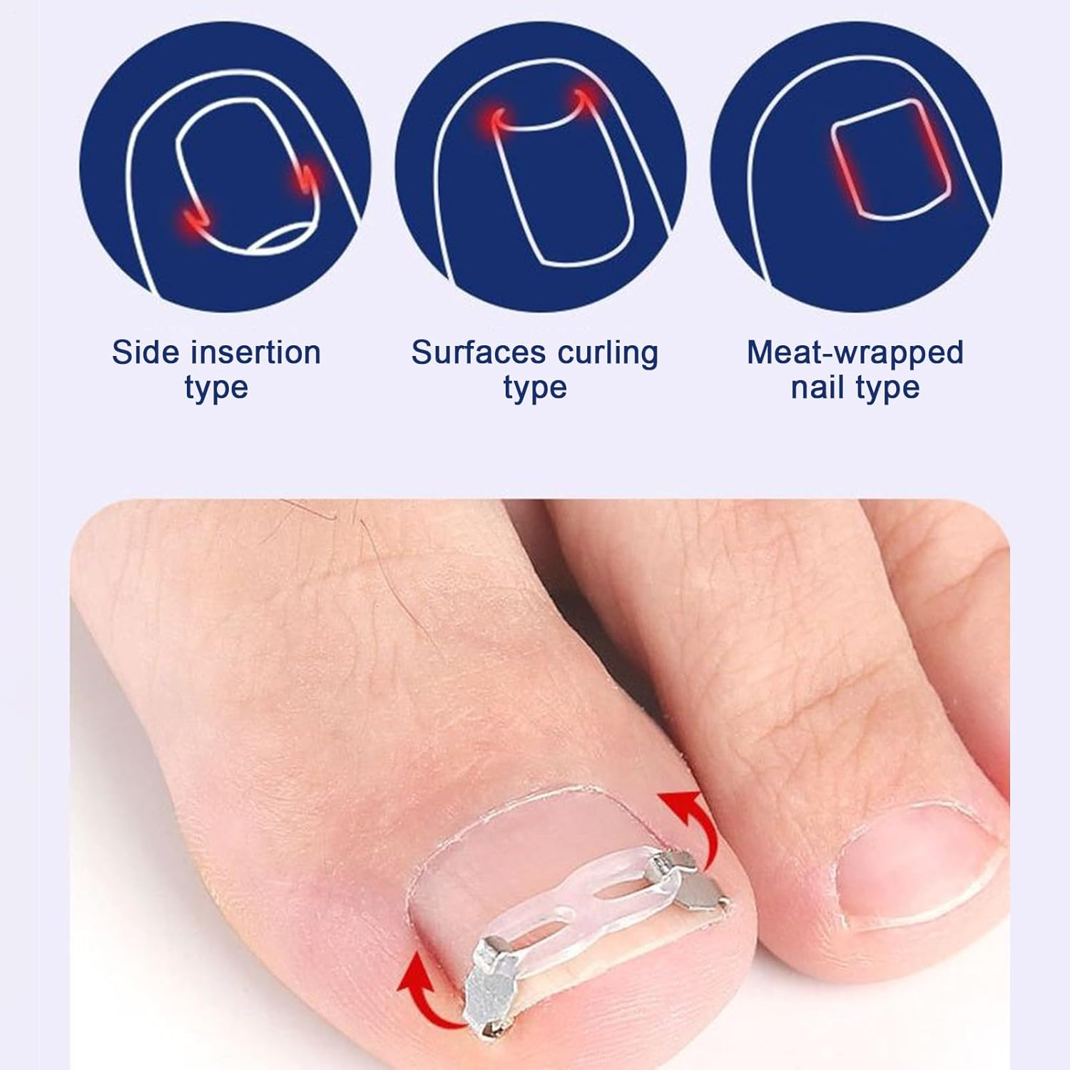 Nail Corrector Patch | Renewal Ingrown Toe Nail Stickers - Breathable Toenail Straightening Tool for Adults Family Friends Foot Care Accessories image number 6
