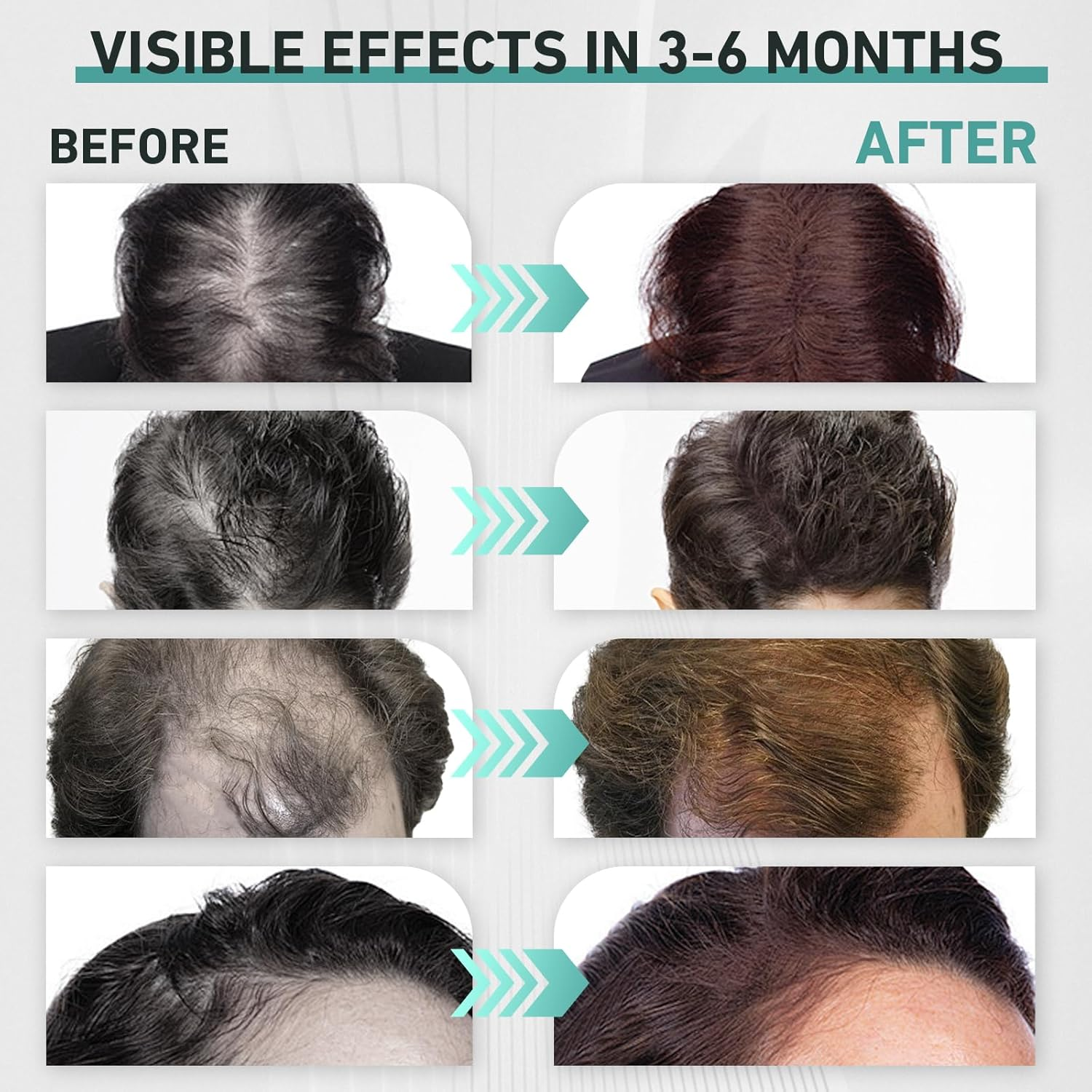 Ikeener Cold  Aser Comb for Hair Growth, 7 * 650Nm Infrared  Ed  Ight  Herapy Massager Brush for Hair Regrowth, Stimulate Hair Follicle Activation & Prevent Hair Loss image number 4