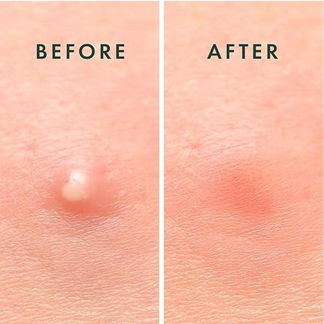 ABC Acne Pimple Patch for Face (36 Dots) | Waterproof Patches for Active Acne | Absorbs Pimple Overnight and Reduces Excess Oil | Facial Patches with 100% Hydrocolloid