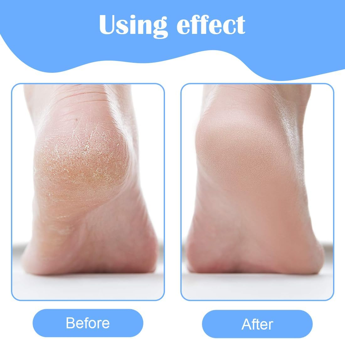 JEYORZY 6-Piece Ingrown Removal Set, Stainless Steel Pedicure Knife Kits with Storage Box, Callus Remover, Callus Remover, Foot Scraper, Pedicure Knife Kits, Foot Care Tools for Hand Feet image number 4