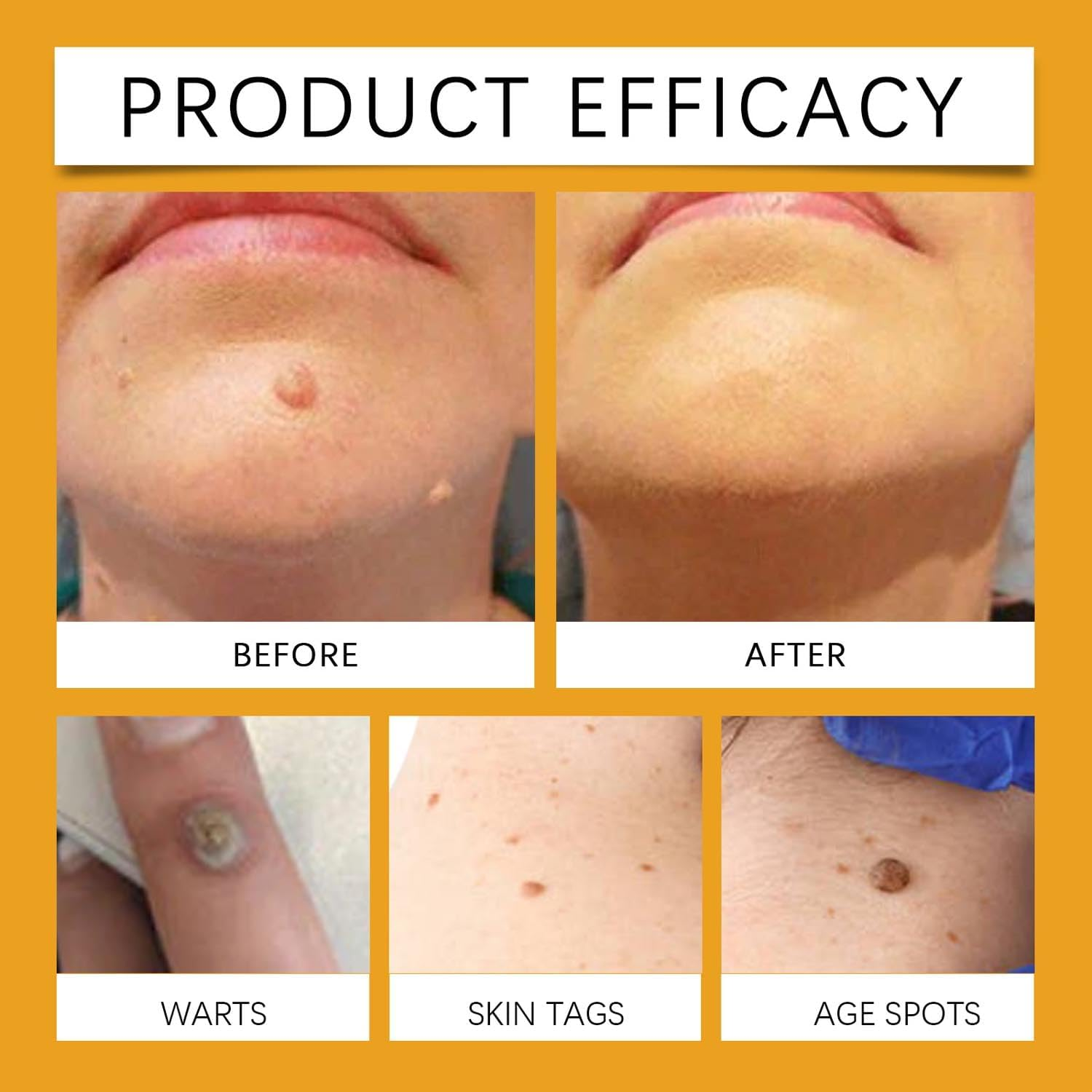 3PCS Bee Venom Treatment Cream,Bee Venom Repair Cream,Bee Venom Wart and Tag Remover,Bee Venom Mole and Wart Treatment Cream,Bee Venom Skin Mark Remover for All Skin Types image number 6