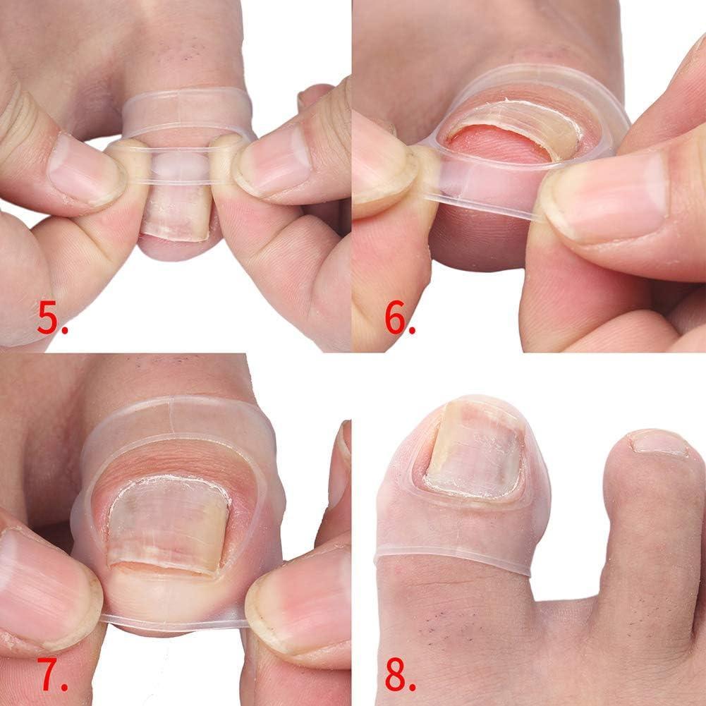 Ingrown Toenail Treatment, Silicone Foot Toe Protector Caps Ingrown Toenail Correcting Tool Pain Relief Paronychia Treatment Corrector for Men Women Pedicure Recovering Healing image number 4