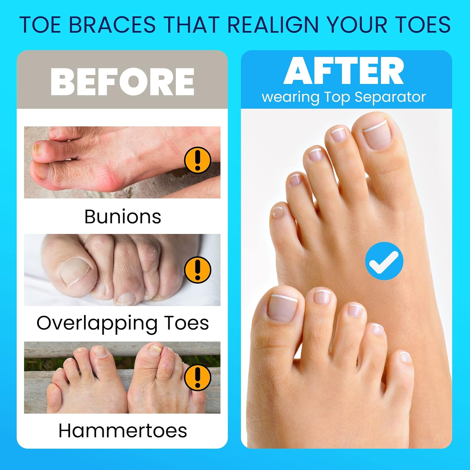 Toe Separators &ndash; 2 Pairs ZANZER Soft Gel Toe Spacer Premium Bunion Corrector for Women & Men,Toe Spacers for Feet for Hammer Toe Straightener,Therapeutic Relief from Plantar Fasciitis,Claw Toes (Black + Black) image number 1