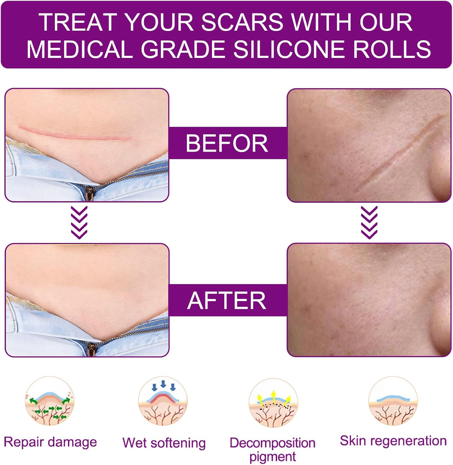 Silicone Scar Sheets - Thick, Silicone Scar Tape (1.6"X 60", 4Cm X 1.5M) - Keloid Bump Removal - Reusable and Effective Scar Removal Strips - Silicone Tape for Scars, Keloid, C-Section, Acne Et image number 3