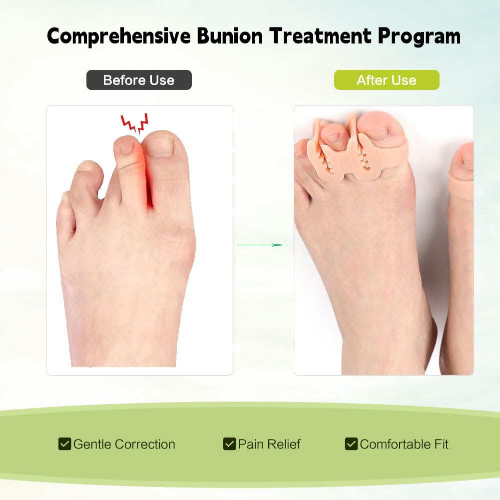 Toe Spacers Double Hole Duckbill Separators，Toe Straighteners，Toe Separators Hallux Valgus Overlapping Toe Hammer Toe Separator，Bunion Corrector for Women，Slippers Sandals Flip Flops 10 Pieces (Gelb) image number 3