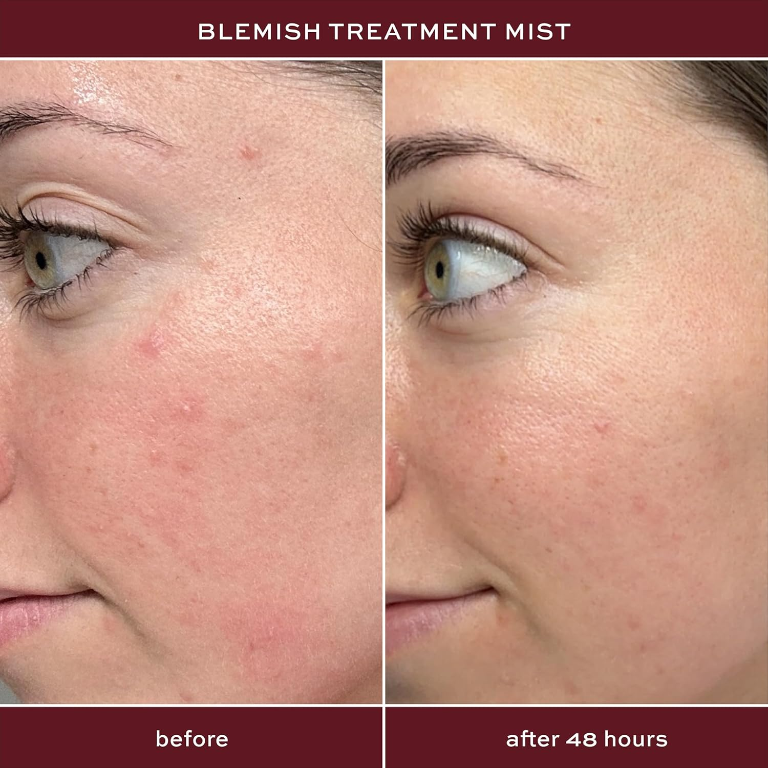 Blemish Treatment Mist by ITK for Unisex - 3.3 Oz Mist image number 2