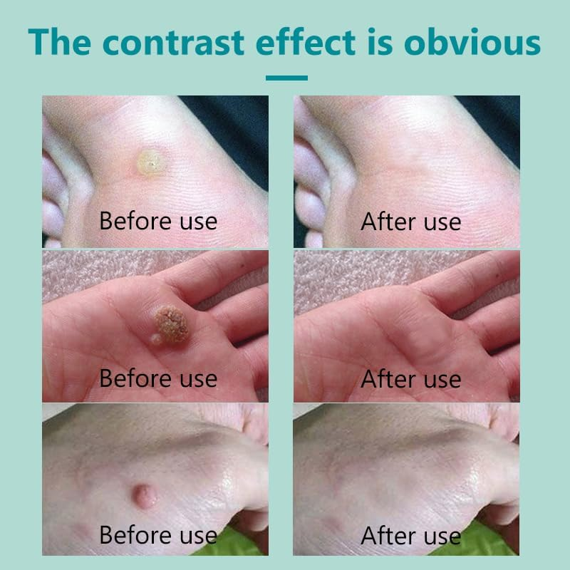 LH Skin Tag Remover, Mole and Skin Tag Corrector, Skin Tag Repair Lotion for All Skin Types, Remove Blemishes Skin Tag Warts, Remove Warts, Flat Warts, Corns, 30Ml