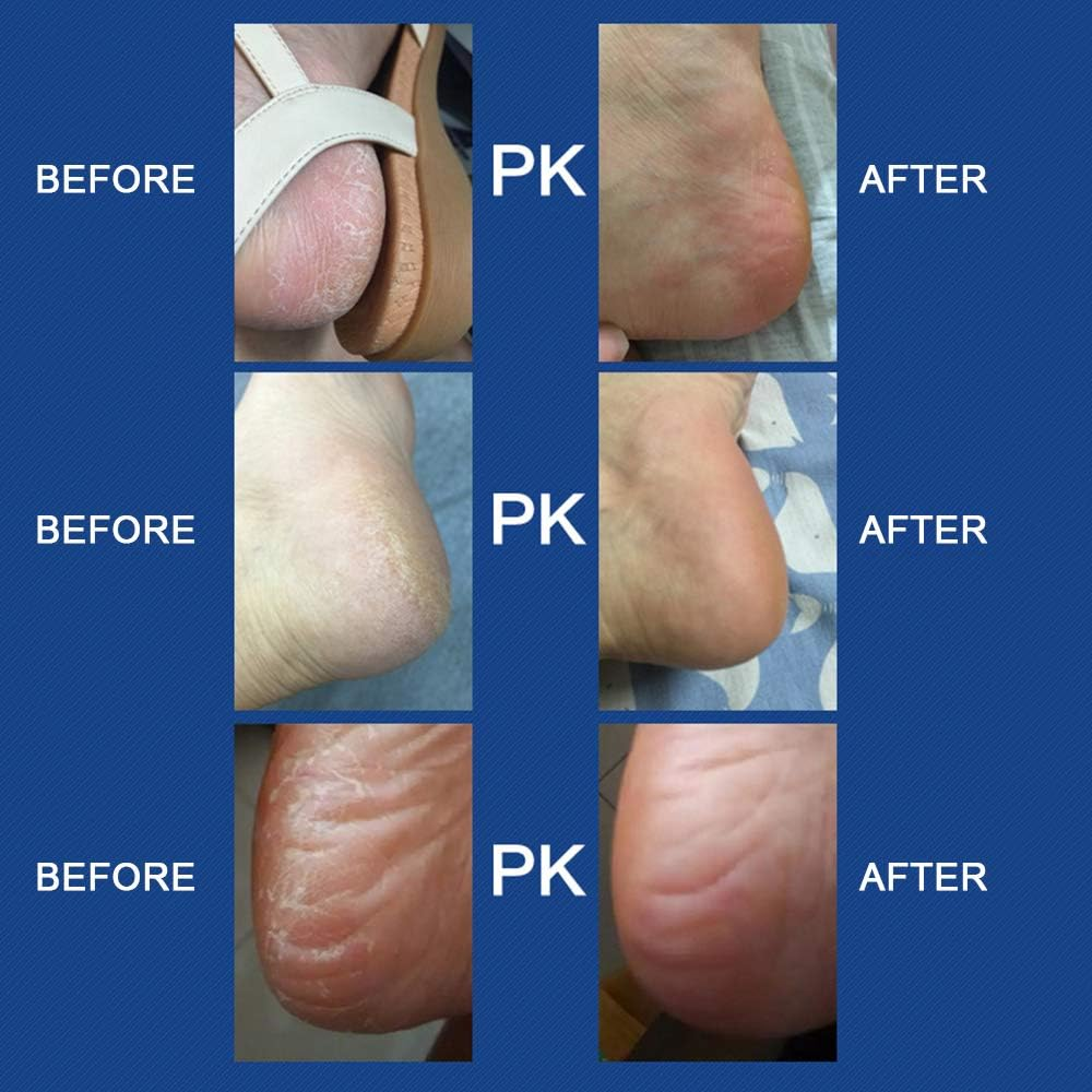 Yasao Electric Foot Grinder with Roller Head Battery Powered Portable Feet File Pedicure Tool Foot Scrubber Callus Remover for Dead Hard Cracked Dry Skin image number 2