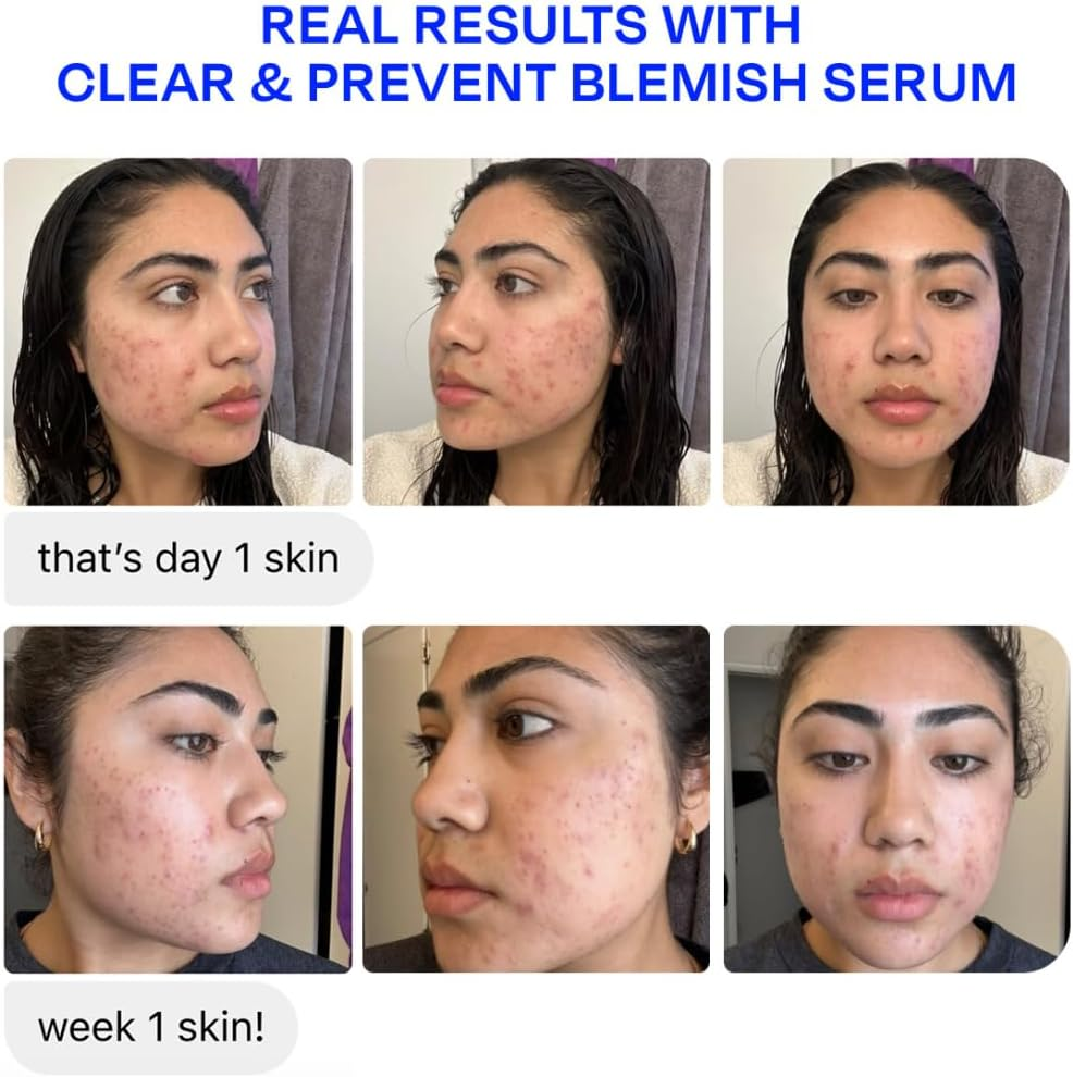 Murad Biome-Balancing Blemish Serum - Salicylic, Mandelic, Glutamic Acid - Helps Clear and Prevent Breakouts, Helps Clear Pores, Supports Skin Microbiome Balance - 30 Ml image number 1