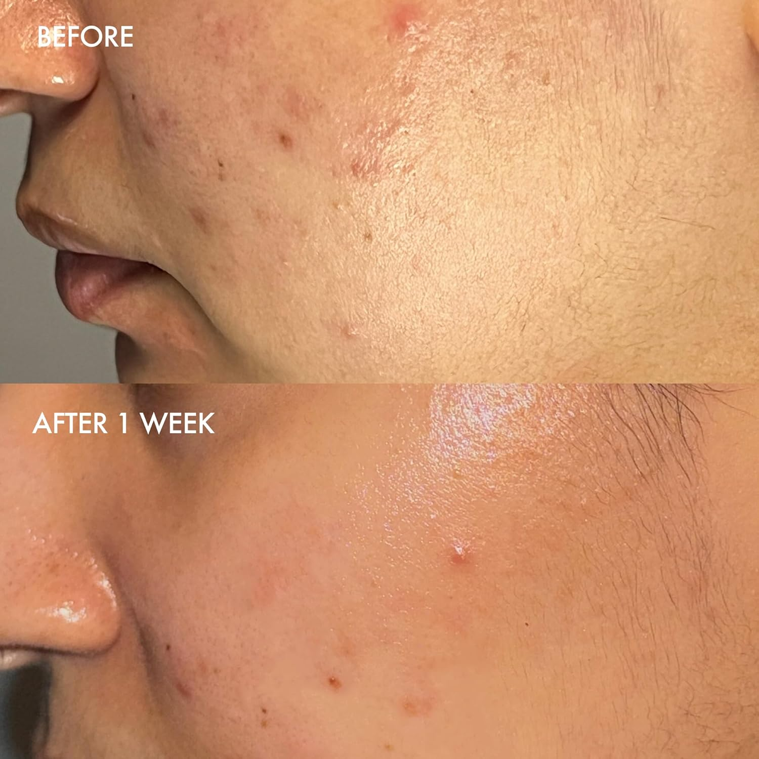 Dermisa Sulfur Facial Bar, 3 Ounce image number 5