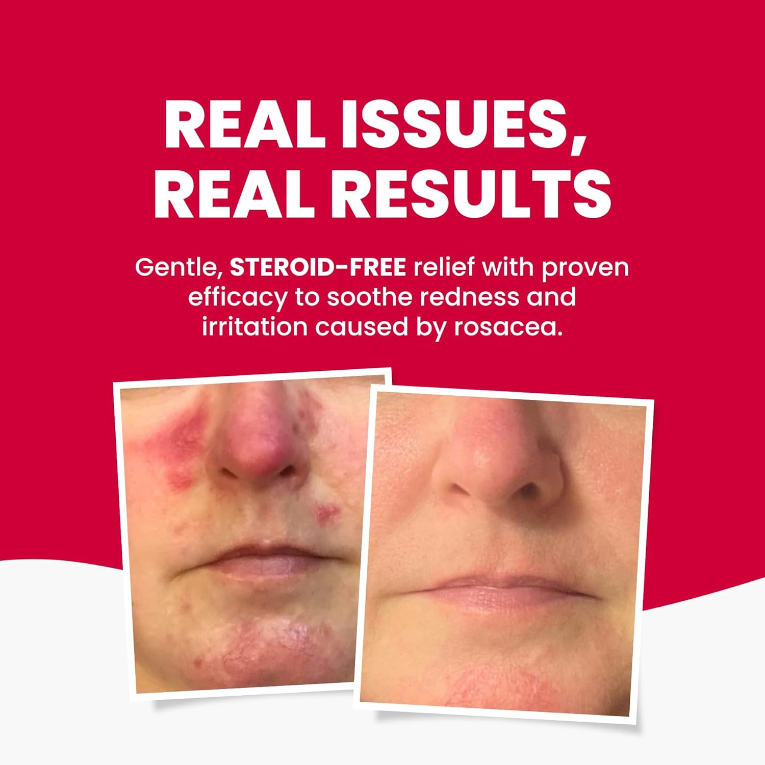 Grahams Class I MD Rosacea Cream 75 G image number 2