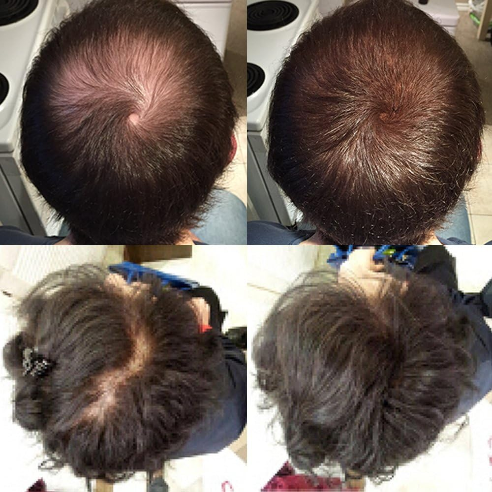 Nor1 Keratin Hair Building Fibers: Hair Fiber Filler and Thickener for Men and Women - Cover up and Concealer for Thinning Areas or Minor Bald Spot - Thicker, Fuller Hair in Seconds - 25 Grams - Dark Brown image number 2