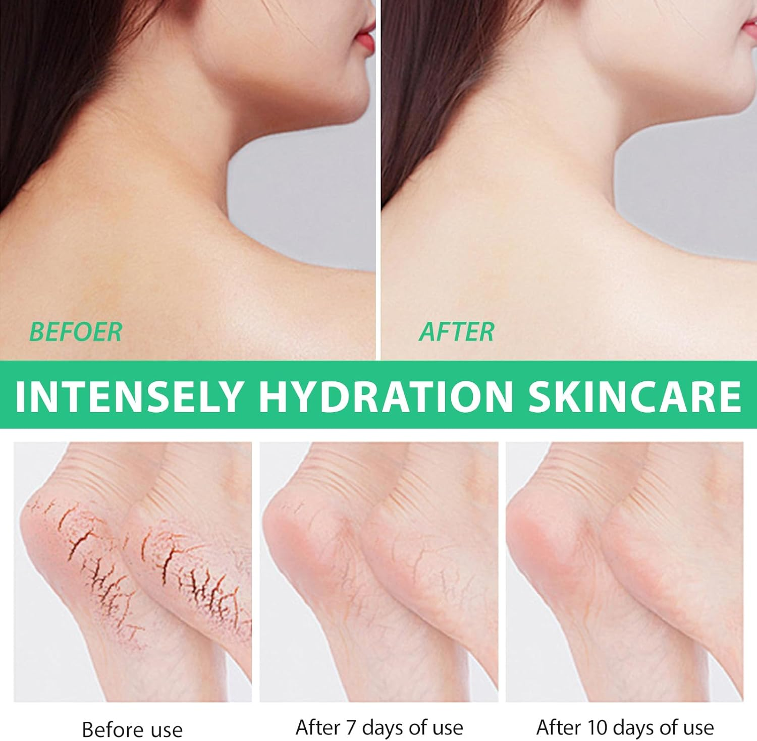 Urea Cream 40 Percent for Feet Maximum Strength,40% Urea Cream plus 2% Salicylic Acid with Hyaluronic Acid,Tea Tree,And Aloe Vera for Foot and Hand - Deep Moisturizes,Callus Remover 3.53 Oz (100G, Urea Cream) image number 2