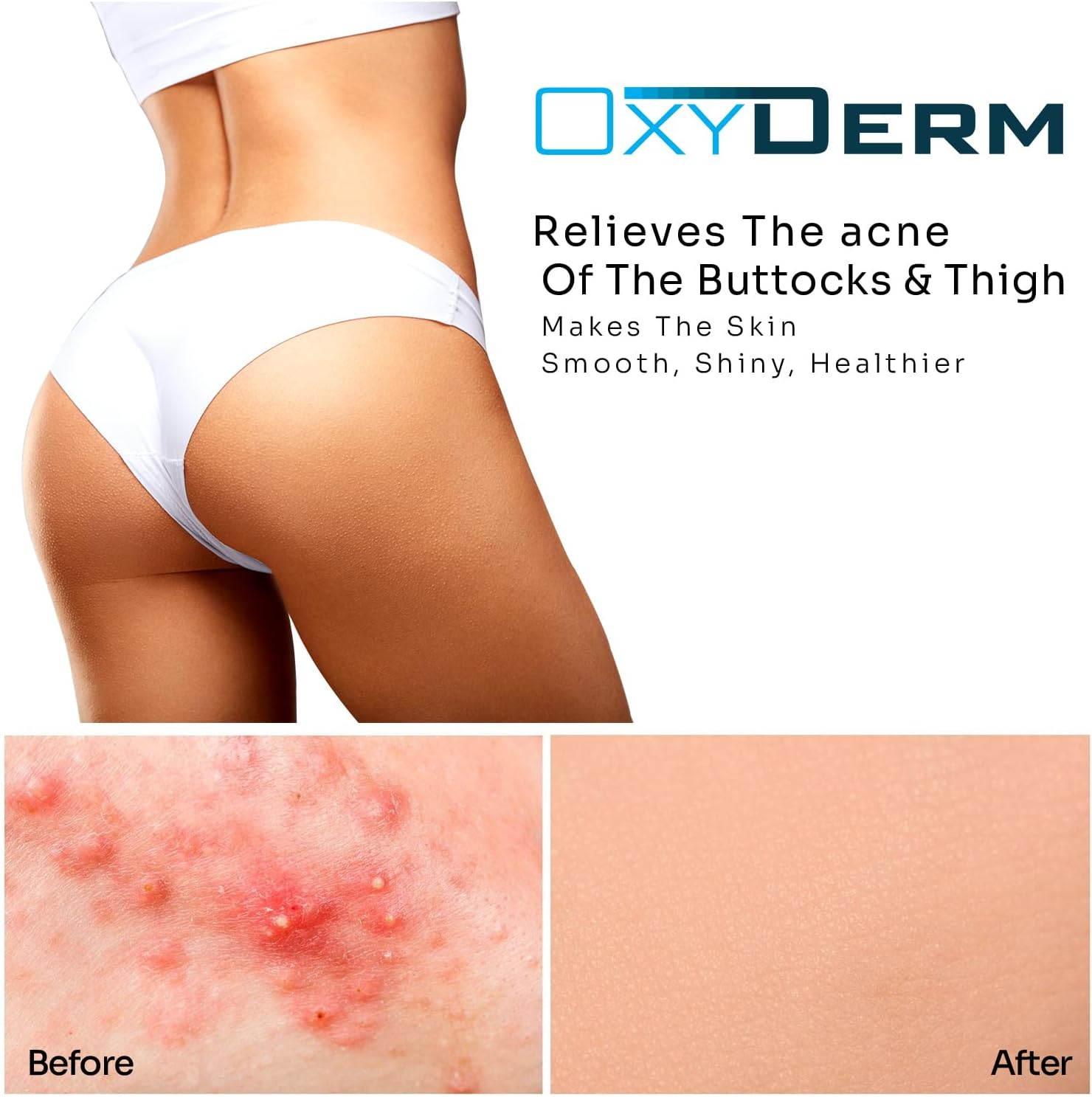 Butt & Thigh Acne Treatment Peel Pads- Exfoliating Treatment Pads to Eliminate Acne Causing Bacteria. Removes Pimples, Blemishes & Ingrown Hairs for the Buttocks & Thigh Area for Both Men & Women. image number 3