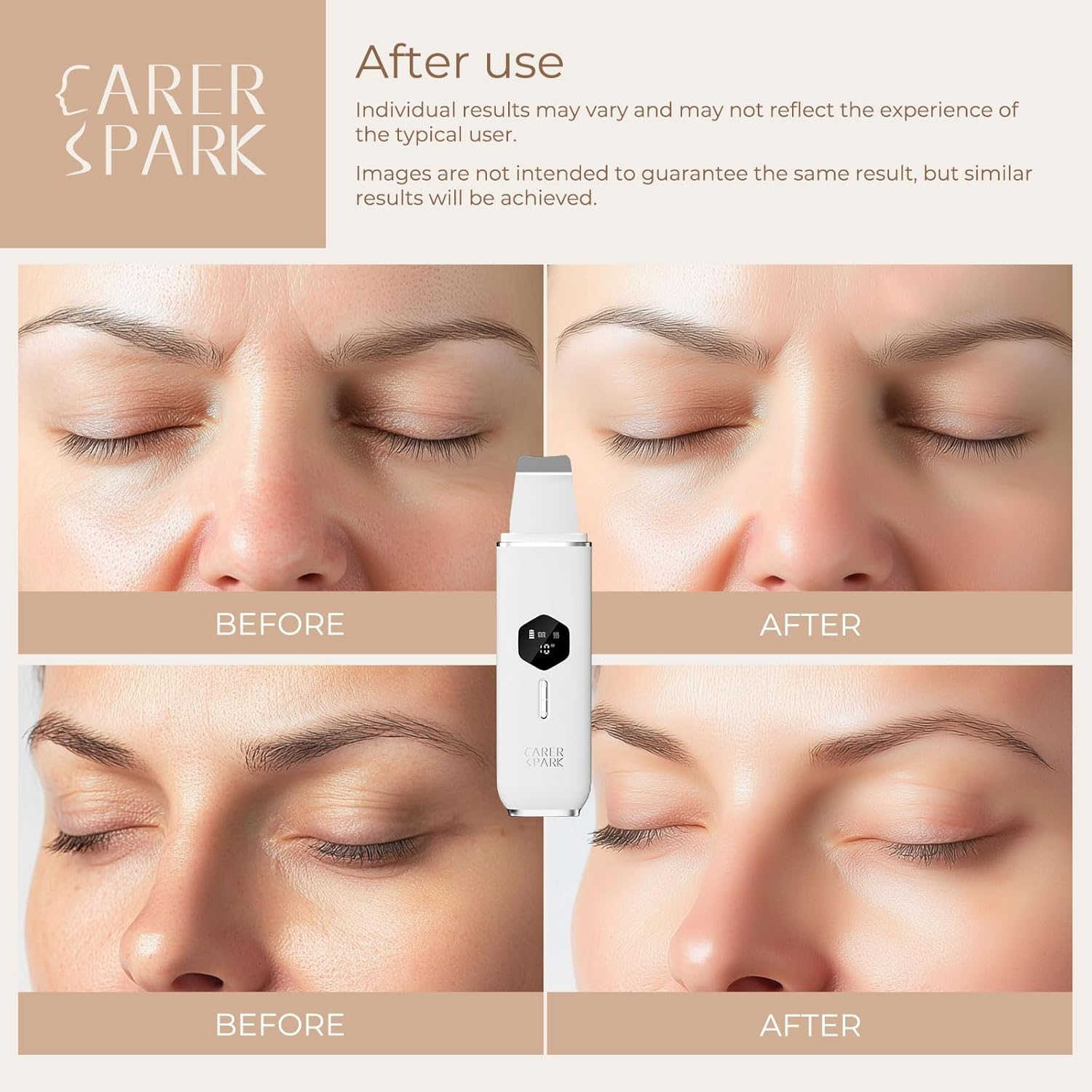 CARER SPARK Skin Scrubber Ultrasonic Exfoliator for Face Blackhead Remover with 4 Modes LED Display, 10 Minutes Auto Shut-Off for Deep Cleaning, Blackhead Removal, USB Charging image number 2