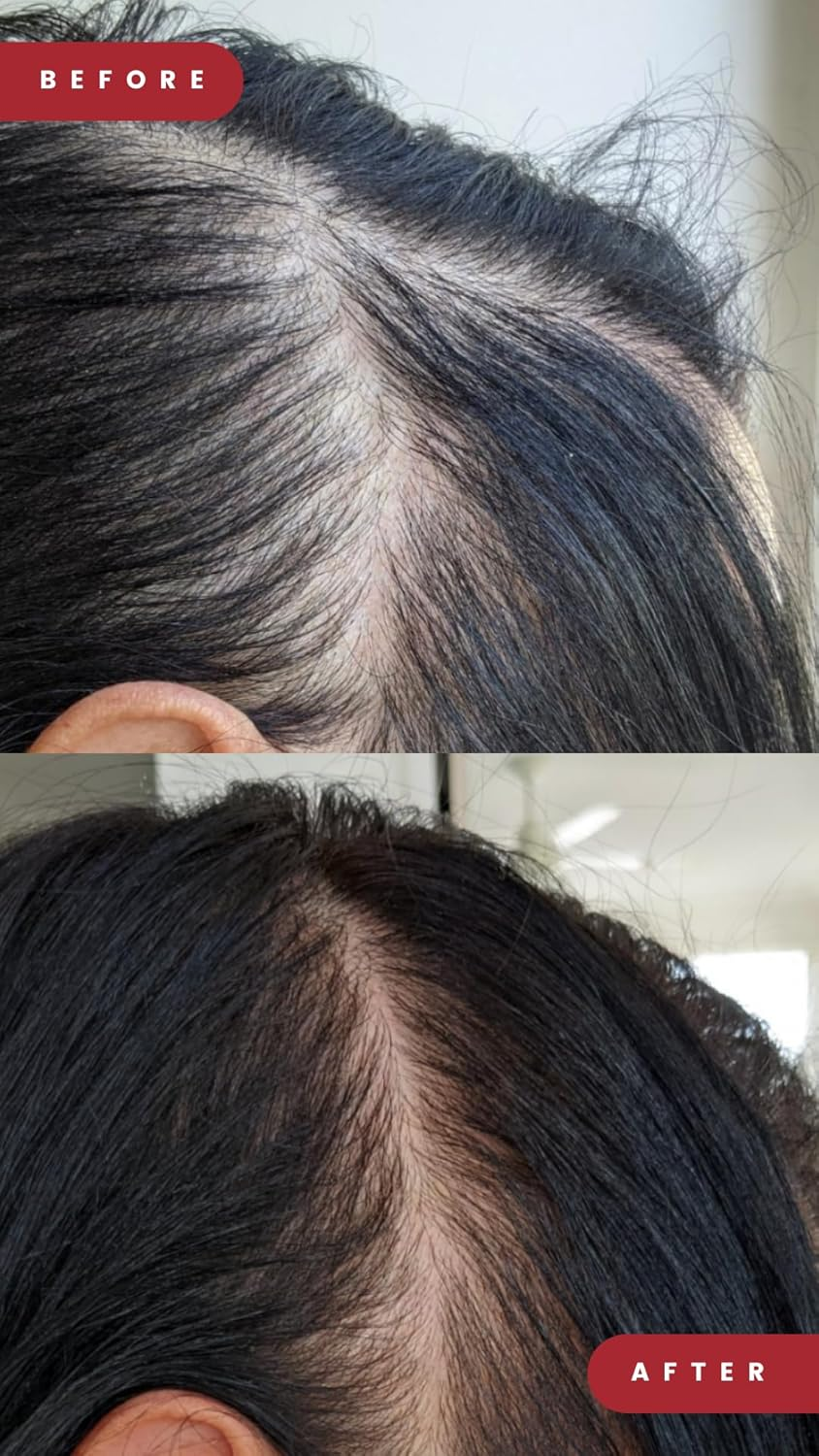 Grow Laser Cap Proflex 302 Medical Grade Laser Diodes for Hair Regrowth Men and Women, FDA Cleared, At-Home Hair Loss Regrowth Device, Low Level Laser Therapy (LLLT) image number 2