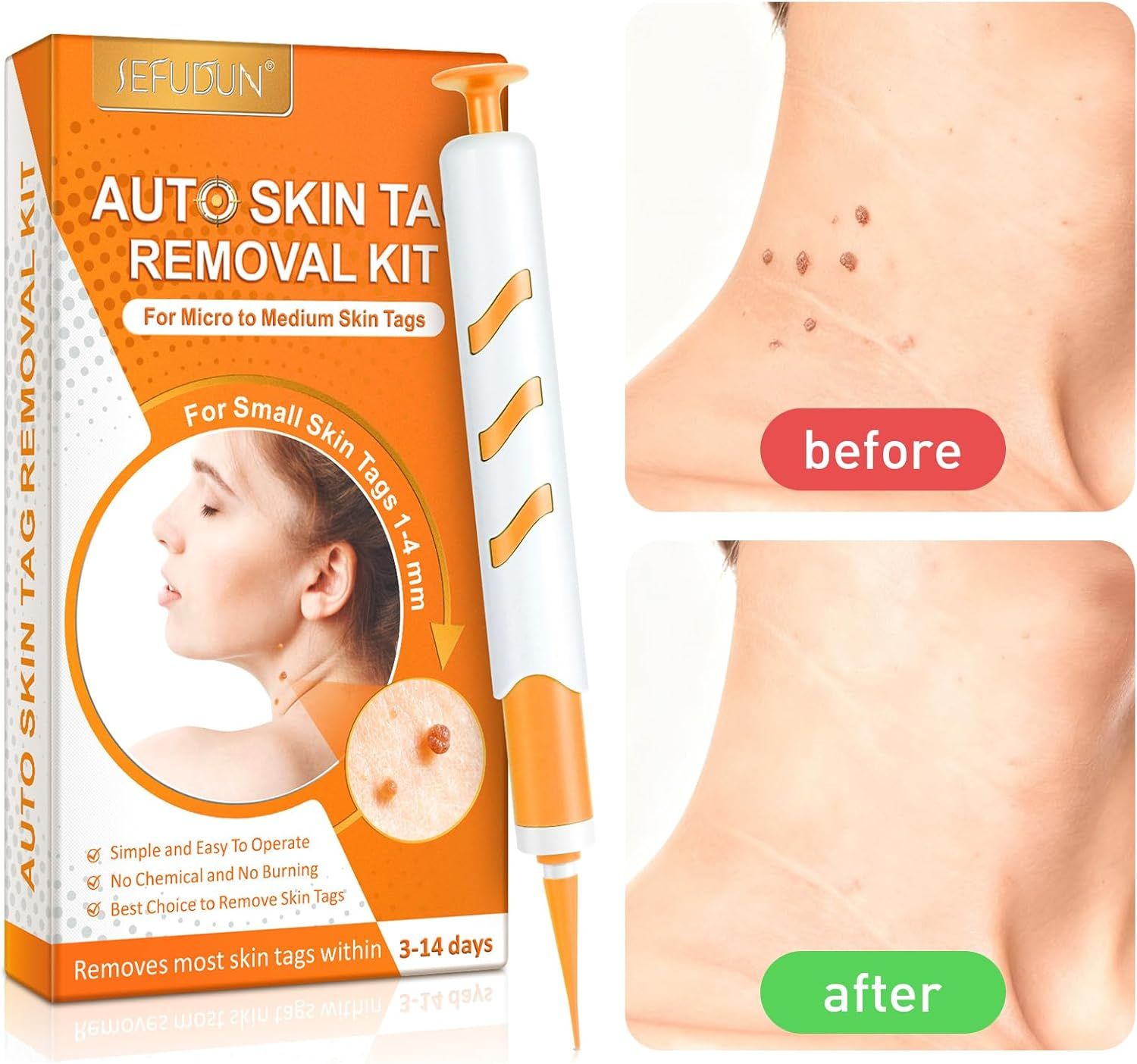 Warts Removal Pen Small Tip Single Set, Skin Tag Remover,Skin Tag Remover Pen,Wart Removal Kit, Safe and Painless, Suitable for Most Body Parts, Including Repair Patches and Cleaning Wipes