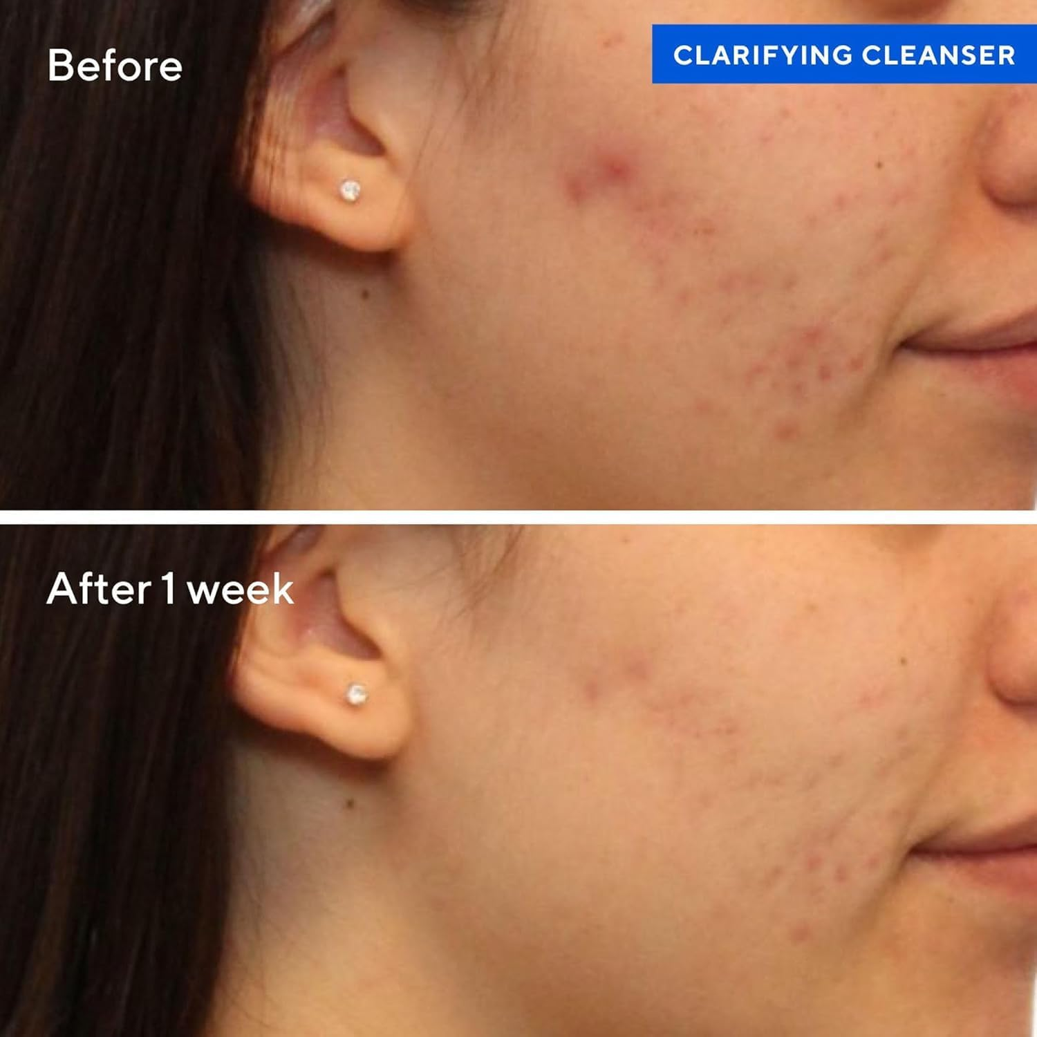 Murad Clarifying Cleanser Gel 148 Ml &ndash; Salicylic Acid Foaming Face Wash and Pore Cleanser for Oily, Combination and Blemish-Prone Skin image number 1