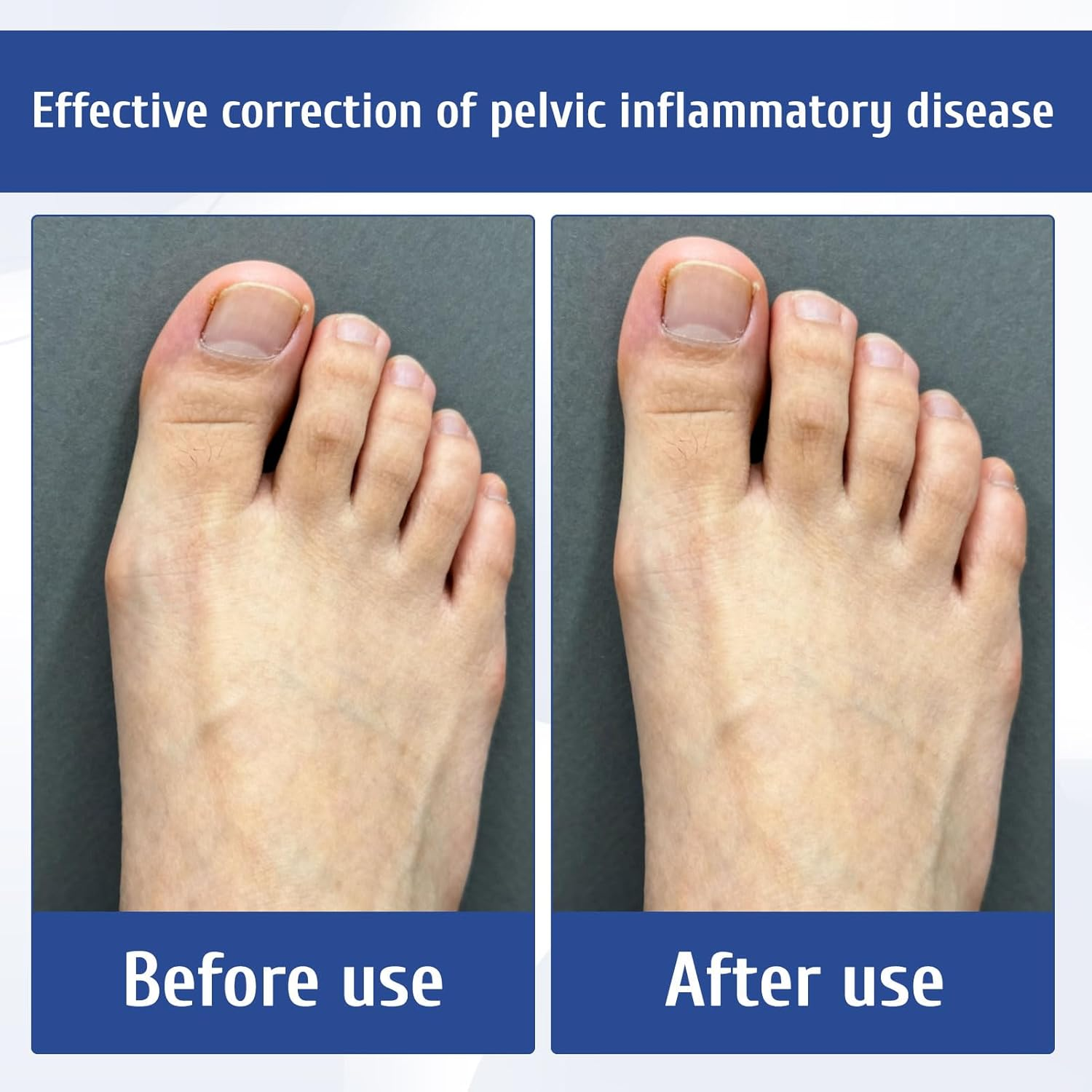 Bunion Corrector, 2Pcs Toe Separators, Toe Separator, Orthopedic Bunion Splint and Big Toe Straightener, Effective Bunion Corrector for Hallux Valgus Pain Relief, Suitable for Men and Women image number 4