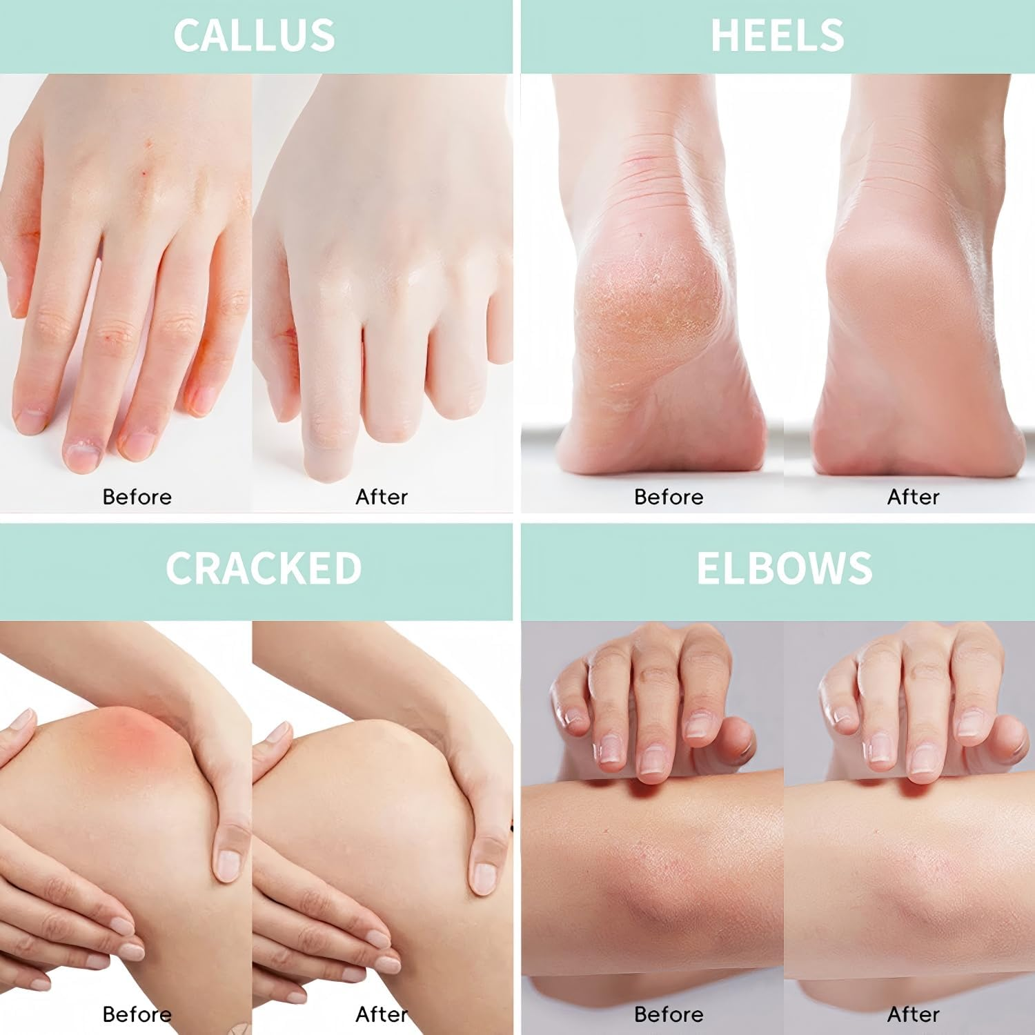 Urea Cream 40%, plus Salicylic Acid 2%, Foot Cream for Thick, Cracked, Rough, Dead & Dry Skin - Corn, Callus Remover and Soften Visit, Moisturizer for Feet, Elbows, Hands and Knees, Keratolytics Skin image number 5