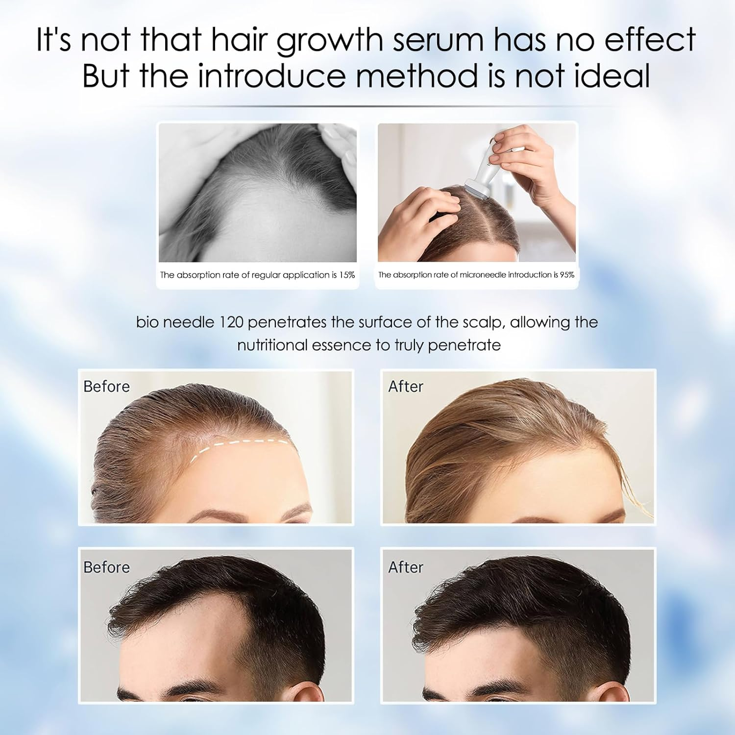 Derma Stamp with 120 Adjustable 2.0Mm Titanium Pins, Derma Stamp for Hair, Beard Growth, Microneedling Pen Micro Needle for Face Skin Rejuvenation, Derma Roller Skin Care Beauty Tool for Women Men image number 6