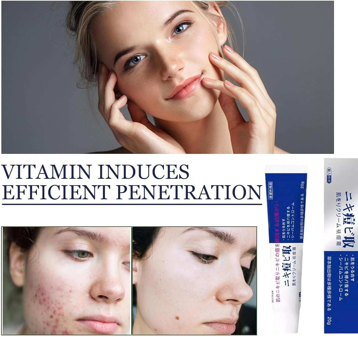 2Pcs Ac-Ne Cream - 20G Pair Ac-Ne Cream Japa, Pair Japanese Ac-Ne Cream, Long-Lasting Moisturizing, No Dryness, Ac-Ne Treat-Ment Removal Cream for Pimples Prone Skin, Mild and Harmless to Skin image number 3