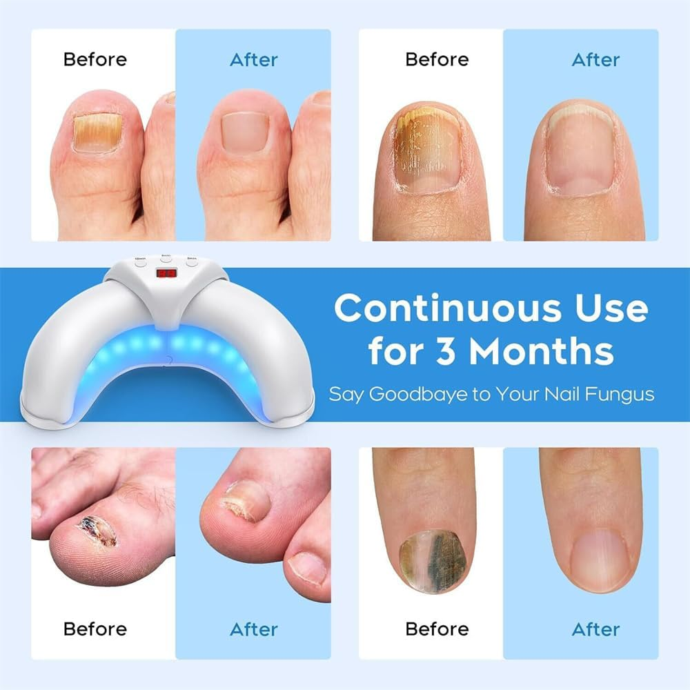 Nail Fungus Cleaning Laser Device Blue Light Nail Therapy for Fingernail Toenail image number 1