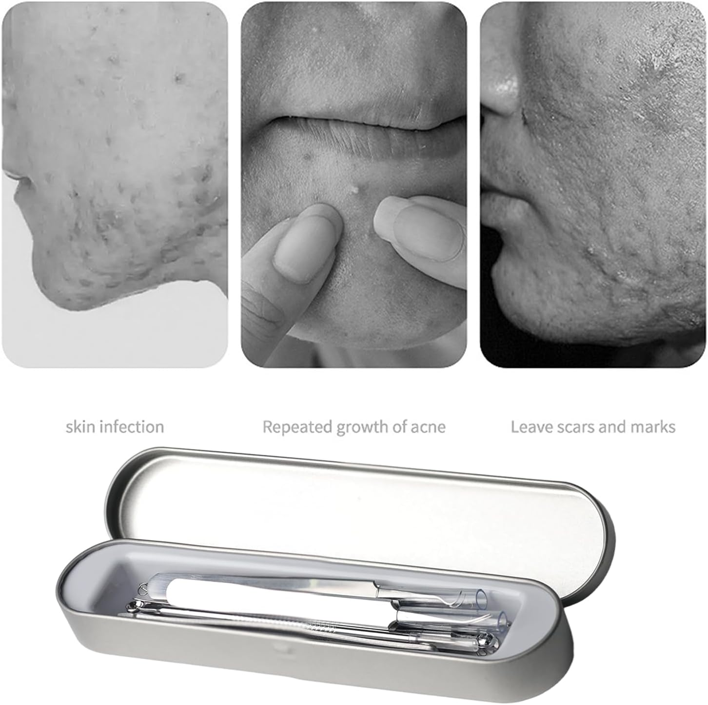 Aiokuo 15-Piece Blackhead Remover Tool Kit with Mirror &ndash; Stainless Steel Pimple Extractor Set with Metal Storage Case, Facial Care Tools for Removing Blackheads and Whiteheads (Silver) image number 4