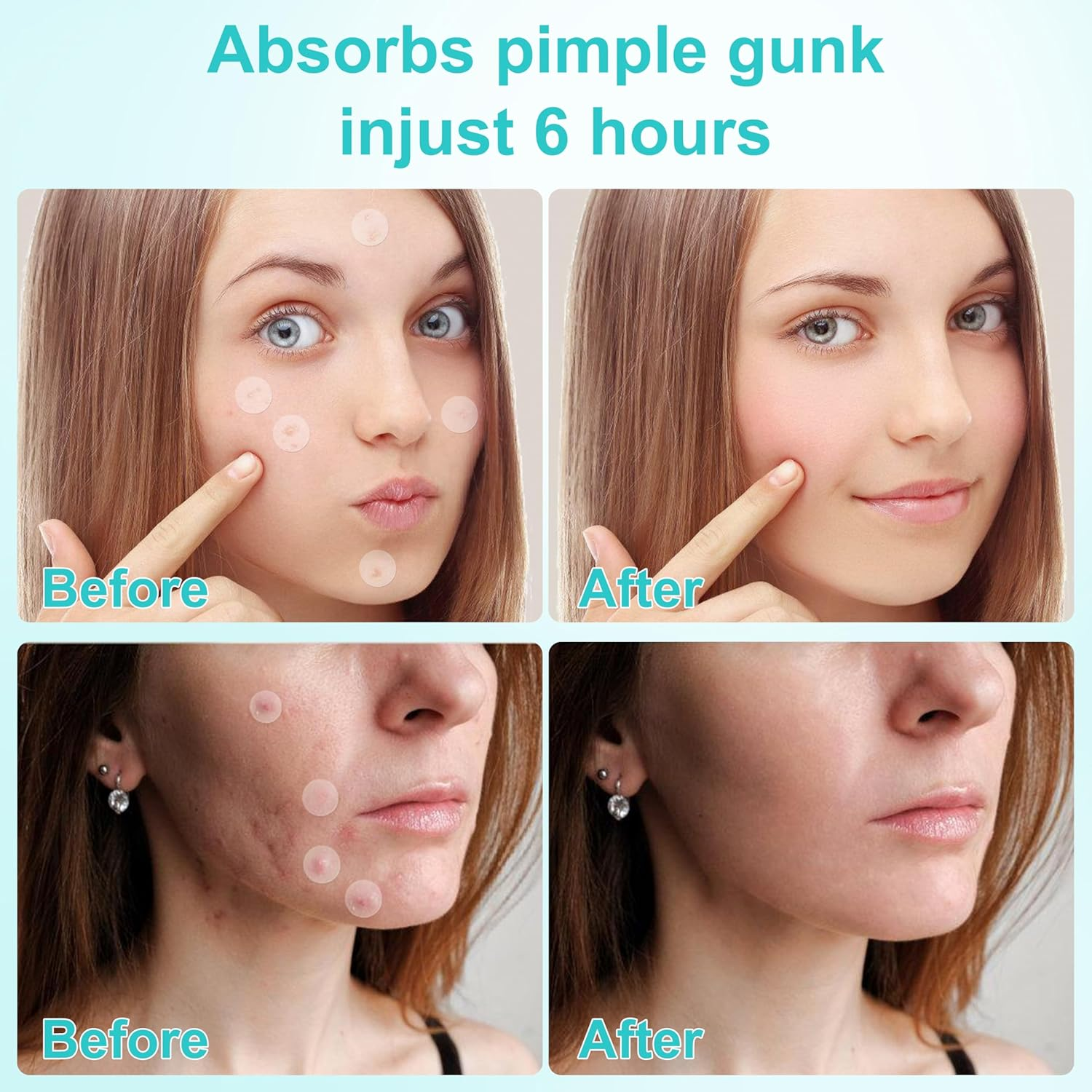 Pimple Patches for Face - Hydrocolloid Acne Patch Invisible (72 Pieces) for Blemish Care, Absorbs Zits, 2 Sizes image number 1