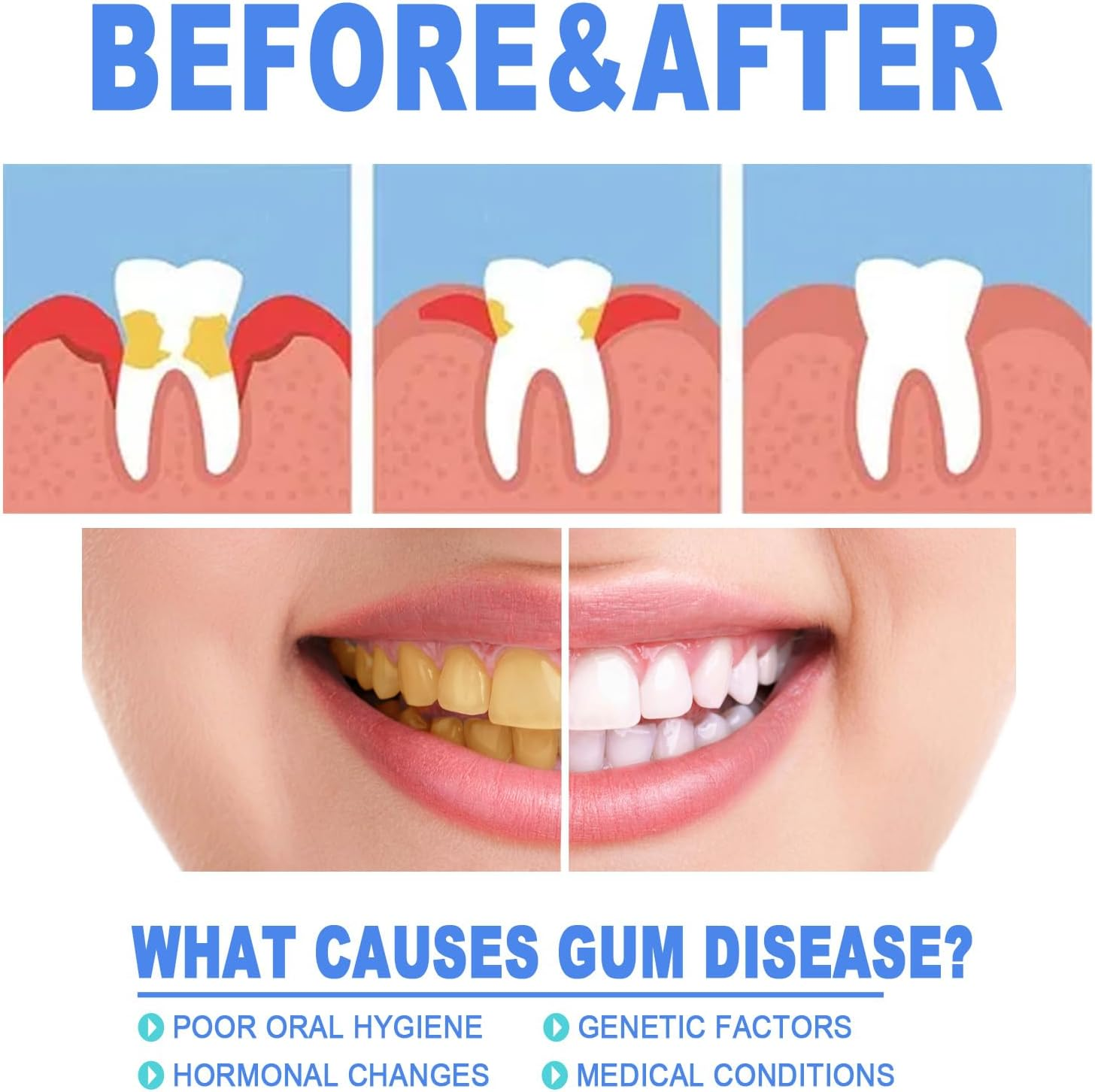 Gum Support Gel for Receding Gums - Protection & Care Formulation Shields Gums, Freshens Breath (4Pcs)